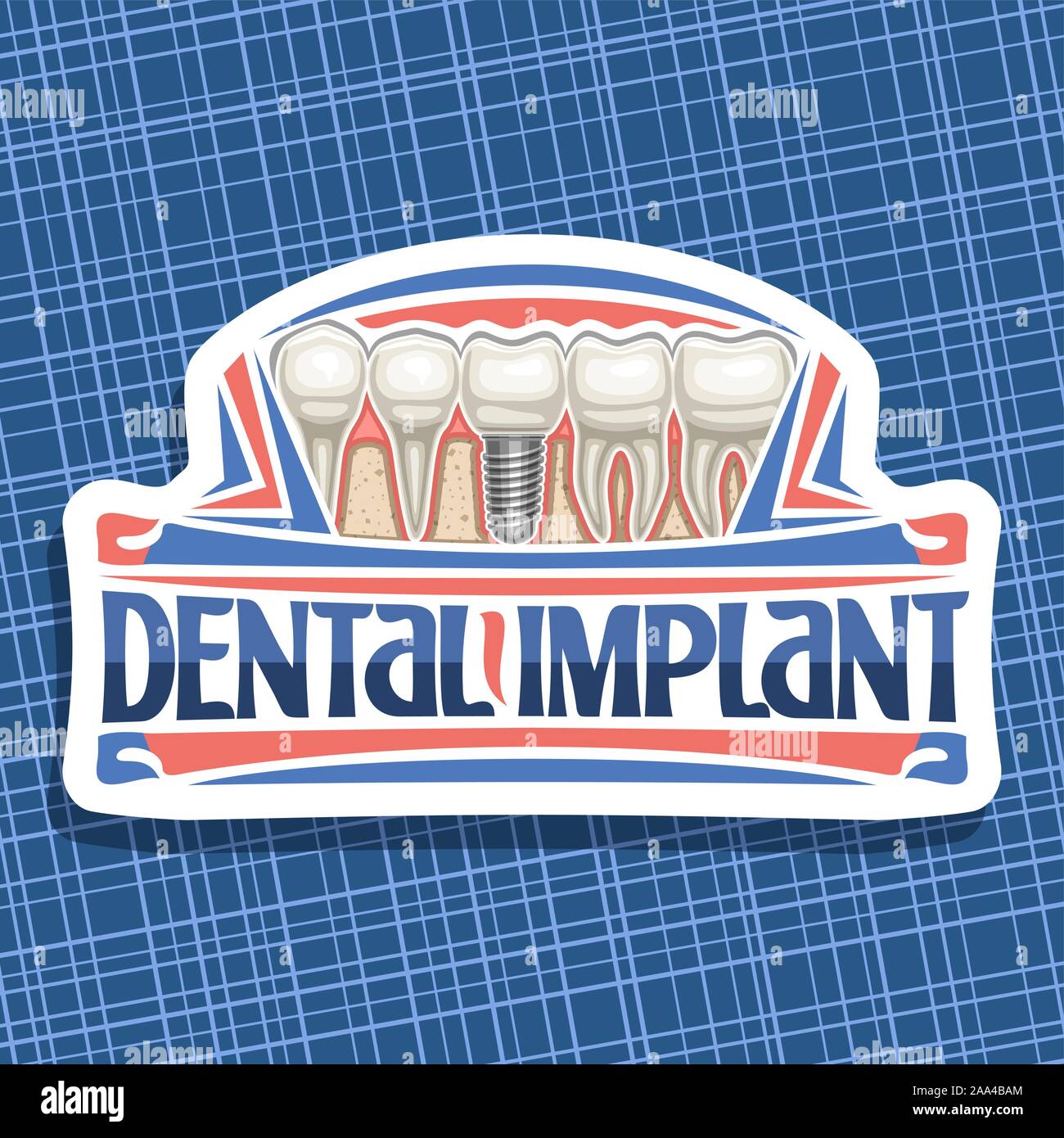 Logo Vector-implants dentaires, blanc avec badge cartoon 5 dents humaines dans la mâchoire, lettrage original des mots, implant dentaire pour panneau de signe Illustration de Vecteur