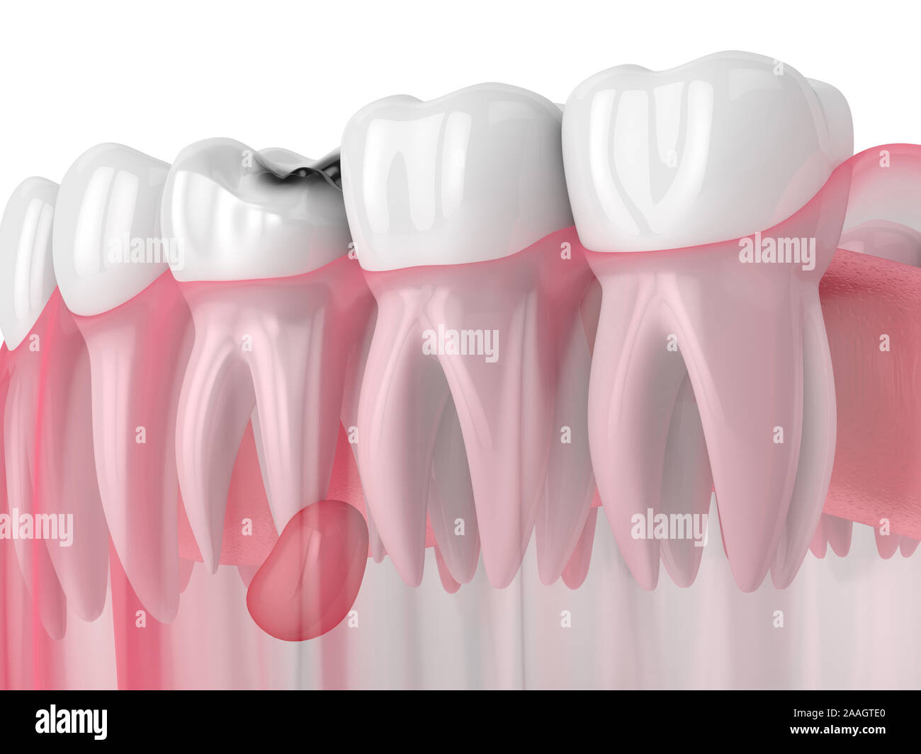 Abces Dentaire Banque D Image Et Photos Alamy