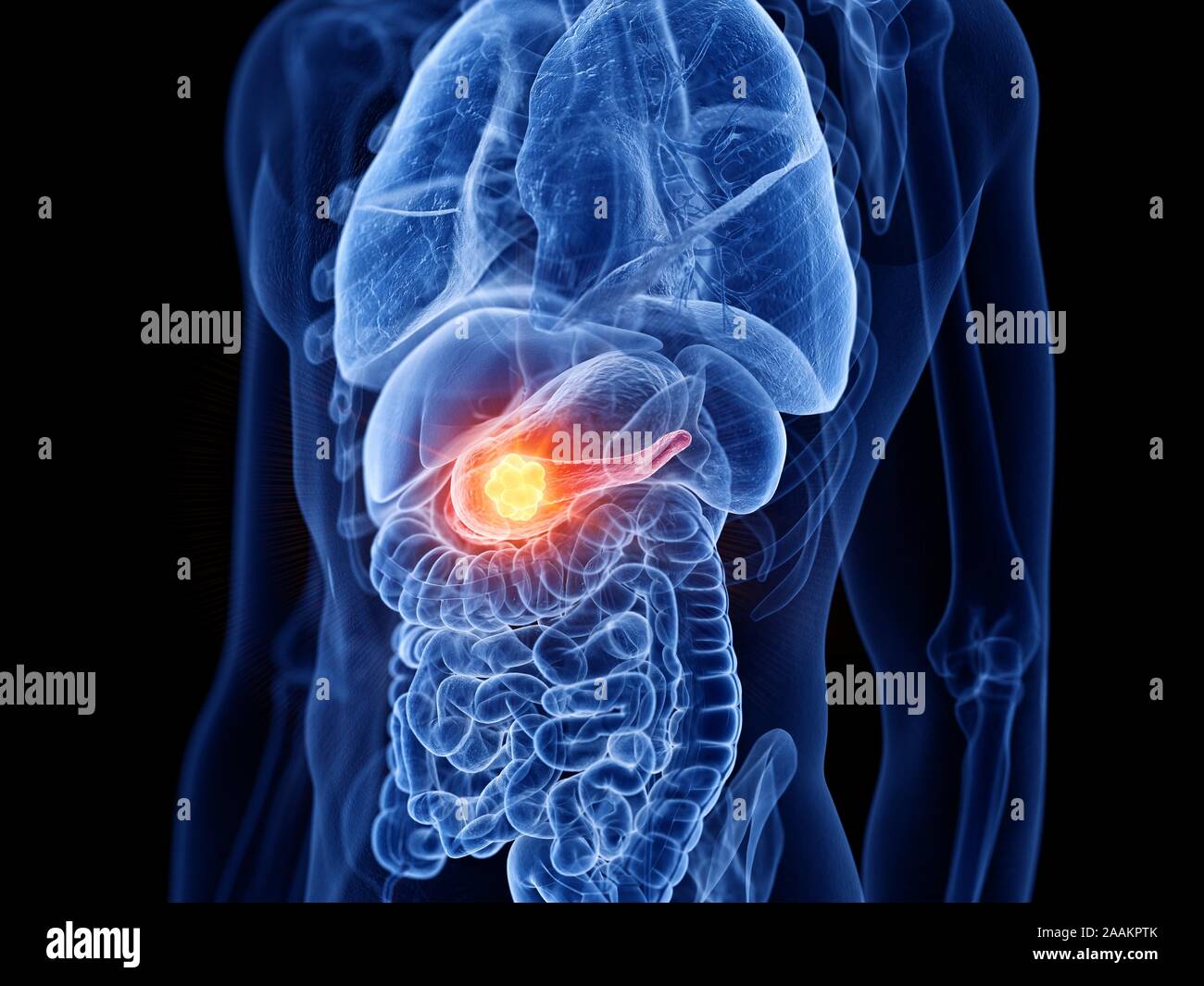 Le cancer du pancréas, l'illustration de l'ordinateur. Banque D'Images