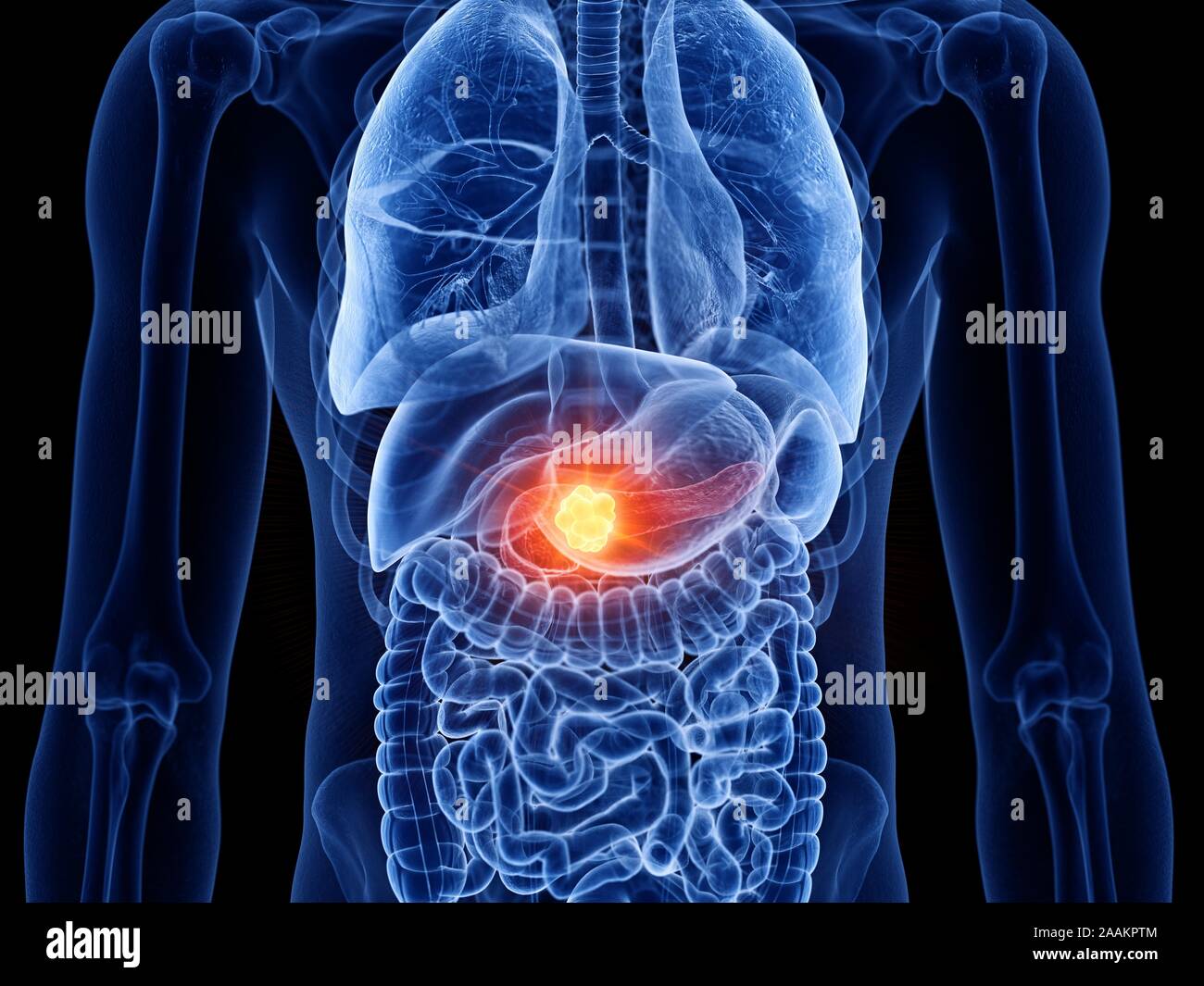 Le cancer du pancréas, l'illustration de l'ordinateur. Banque D'Images
