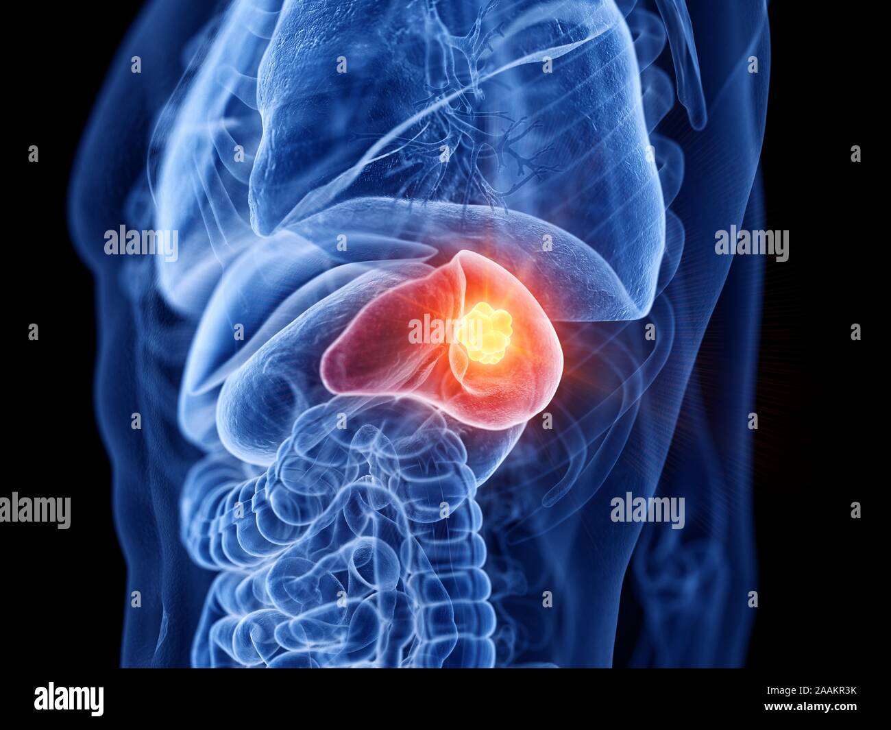 Le cancer de la rate, l'illustration de l'ordinateur. Banque D'Images