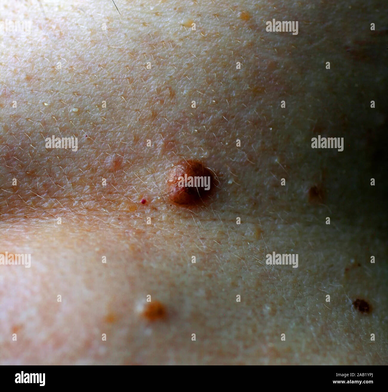 Mole sur la peau du corps. Tâche de naissance. Acrochordon. Banque D'Images