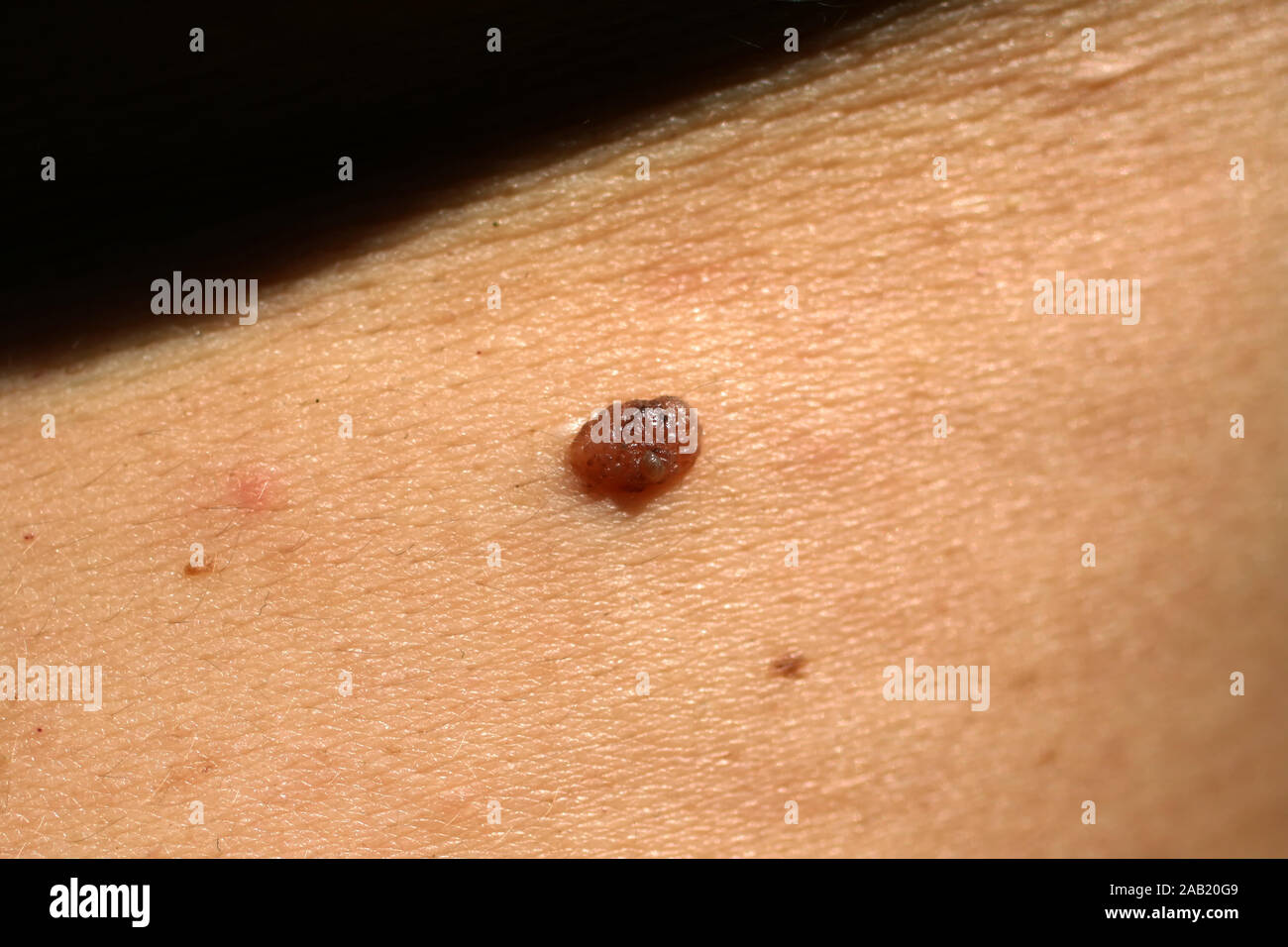 Mole sur la peau du corps. Tâche de naissance. Acrochordon. Banque D'Images