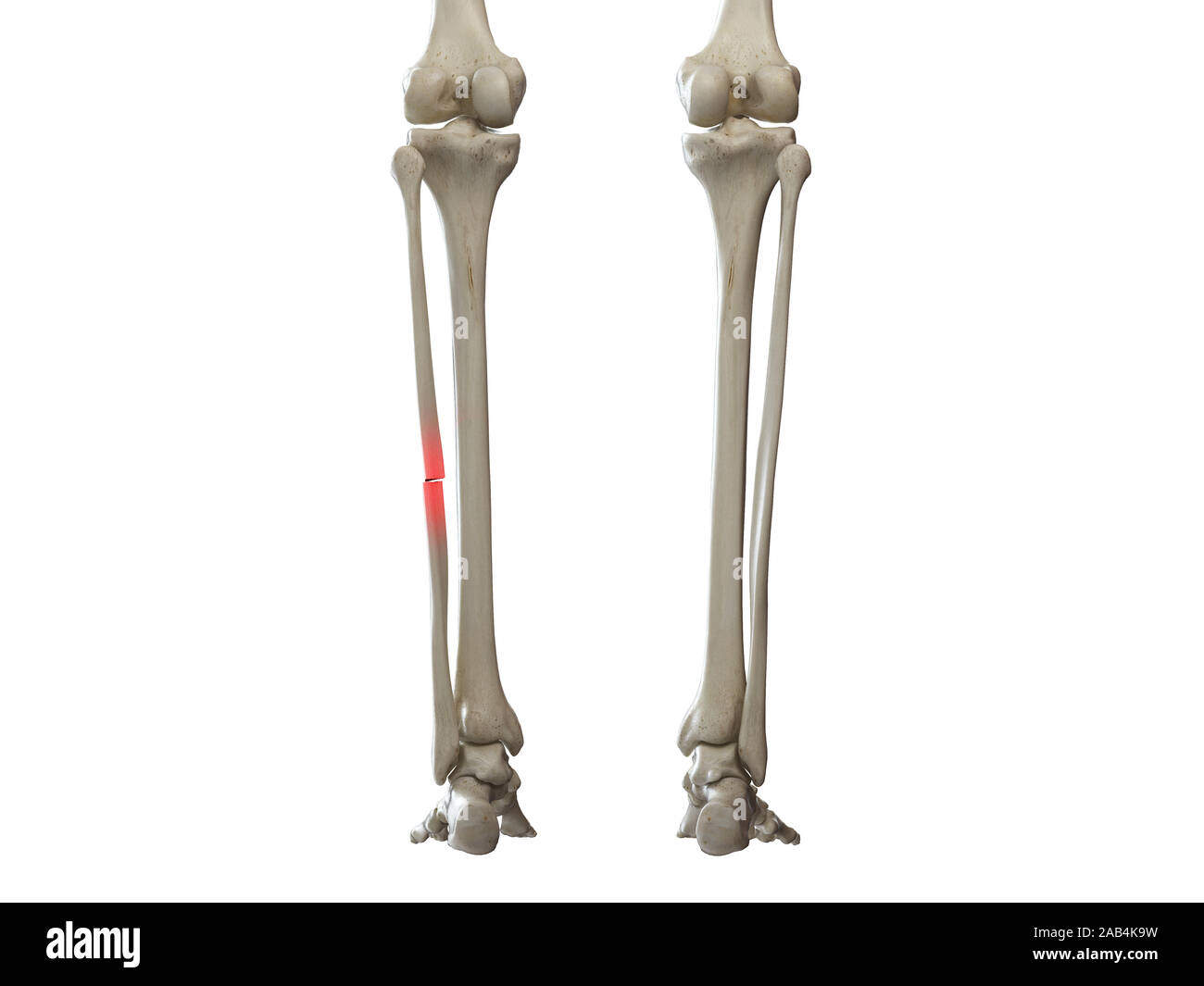 Fracture du péroné Banque d