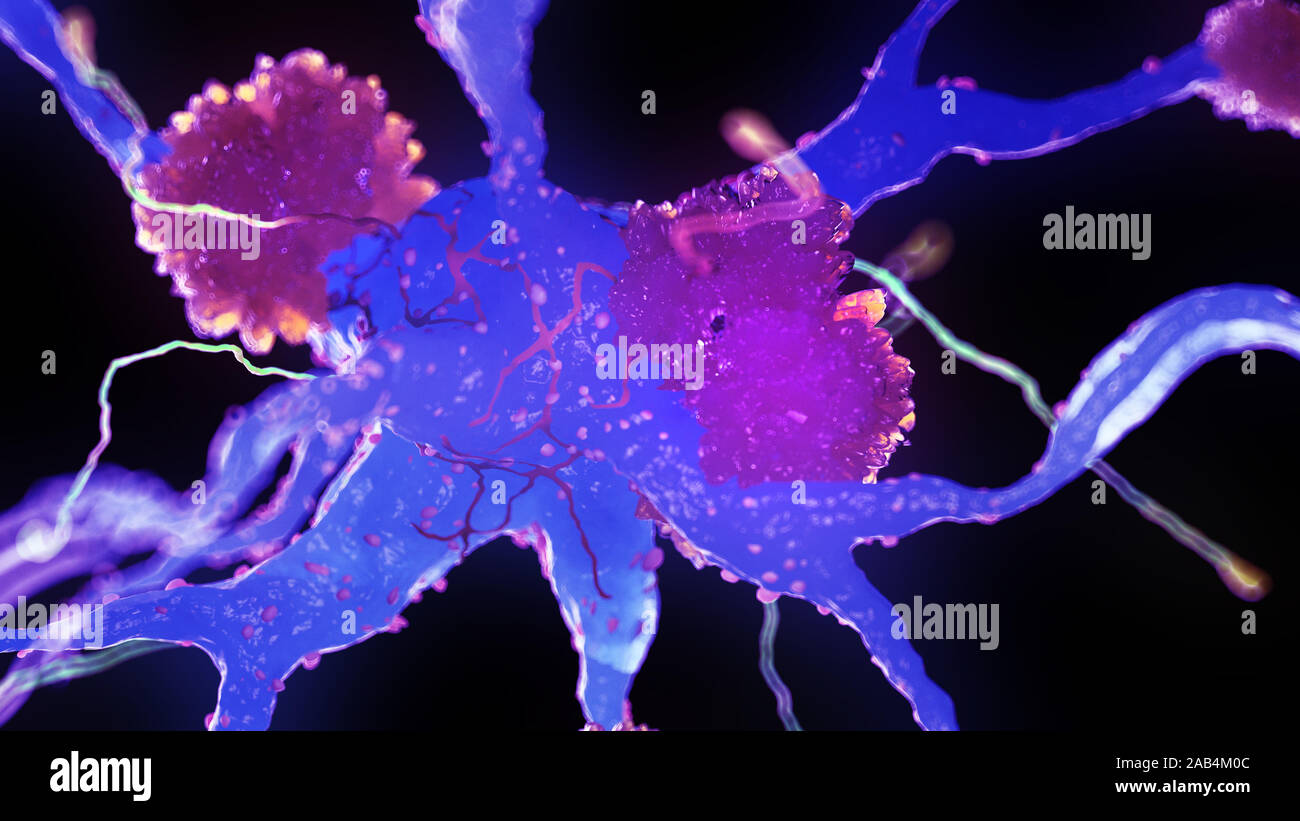Rendu 3d illustration médicale des cellules nerveuses atteintes de la maladie d'alzheimer Banque D'Images