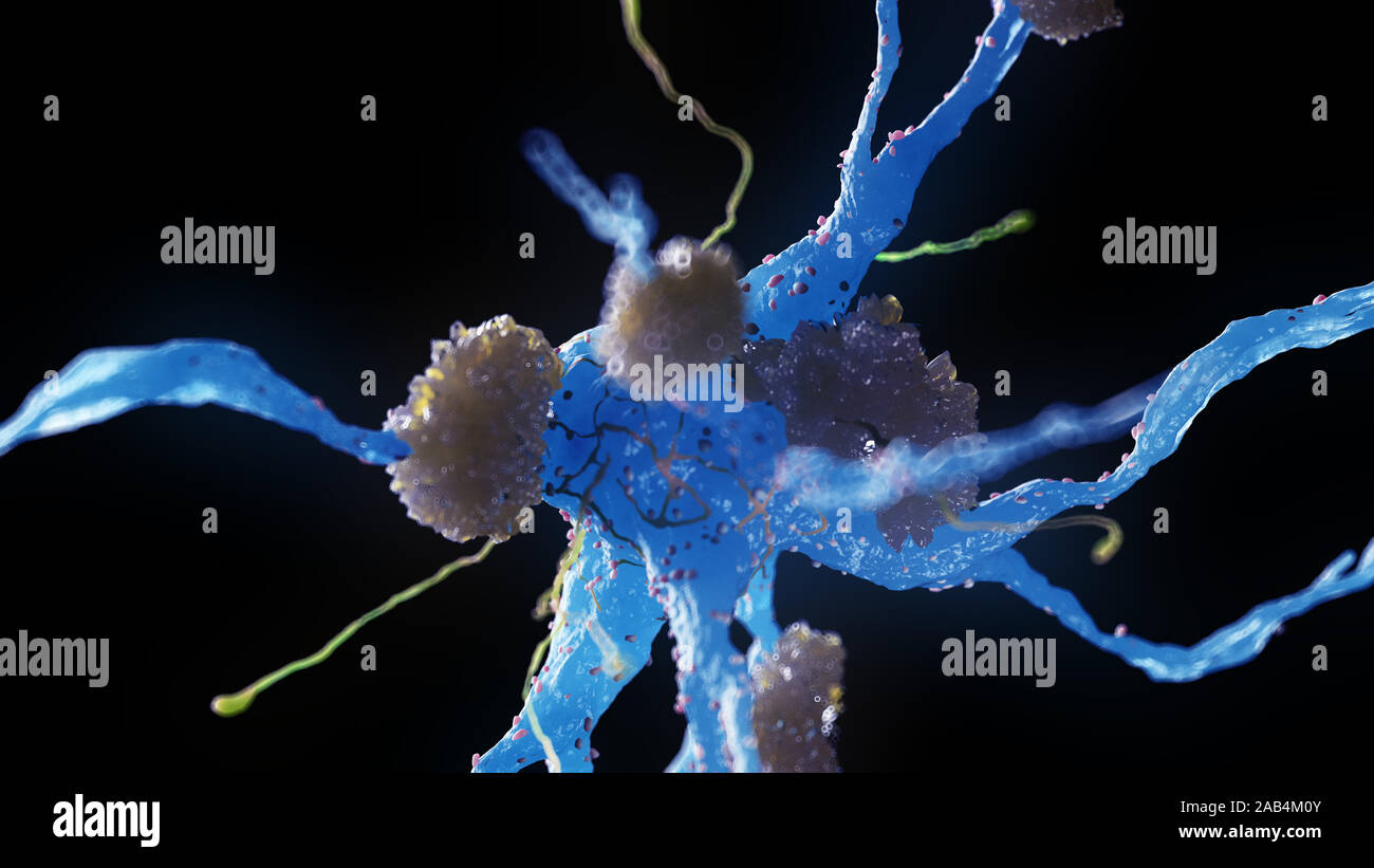 Rendu 3d illustration médicale des cellules nerveuses atteintes de la maladie d'alzheimer Banque D'Images