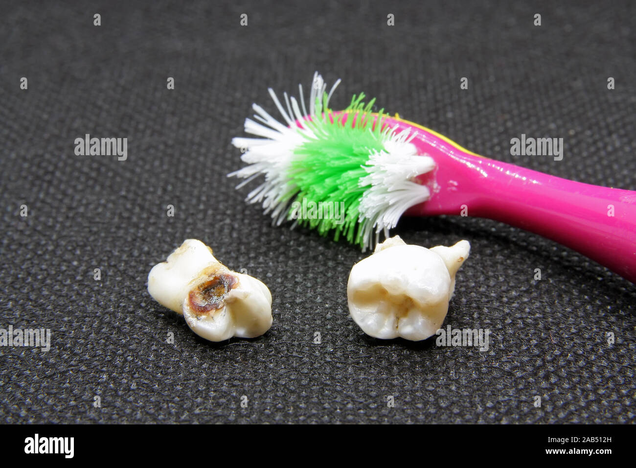 Mauvaise dent et brosse à dents. L'hygiène dentaire dents pourries.et brosse à dents. Dent extraite. Banque D'Images