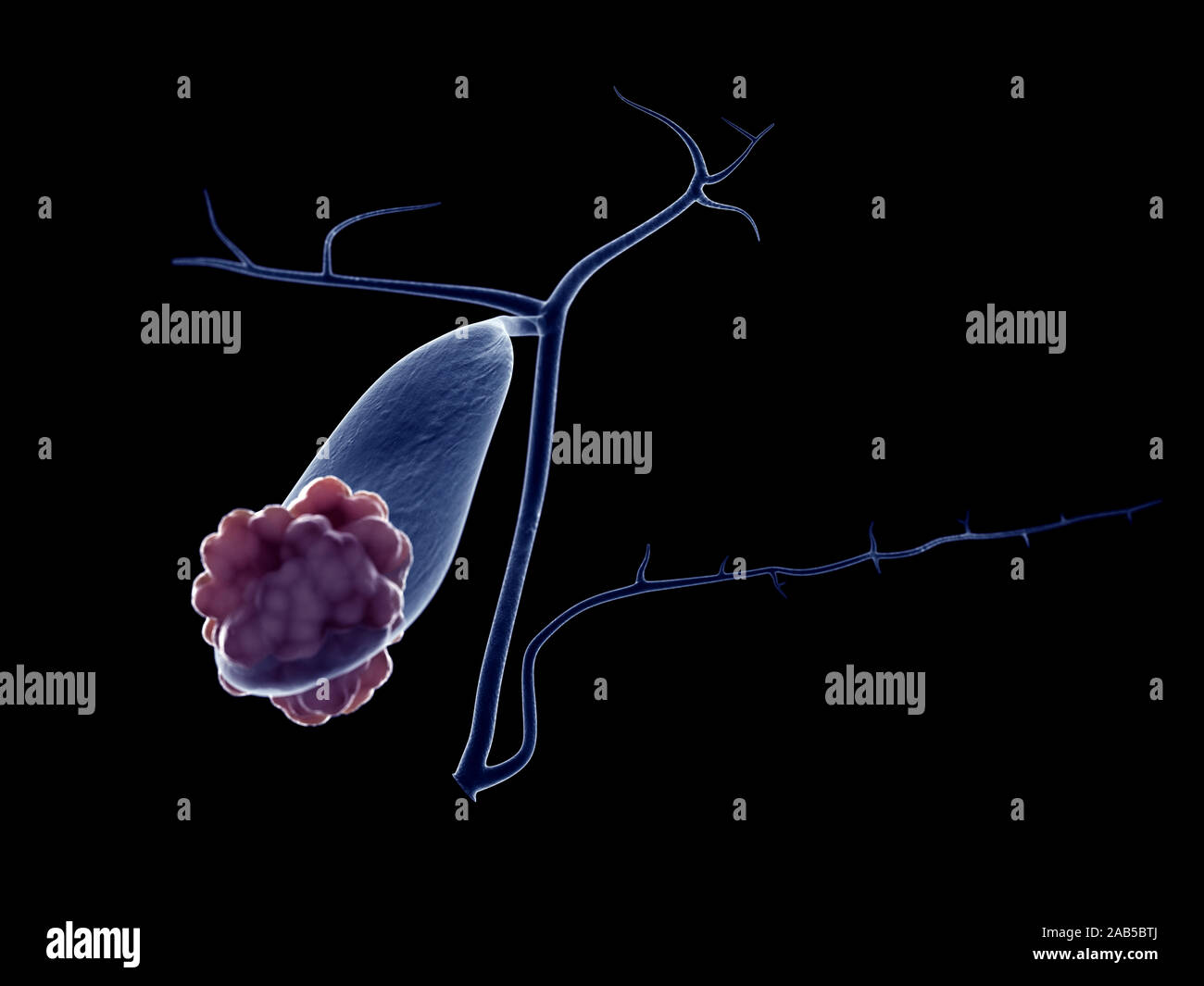 Médicalement en rendu 3d illustration d'un précis des tumeurs de la vésicule biliaire Banque D'Images