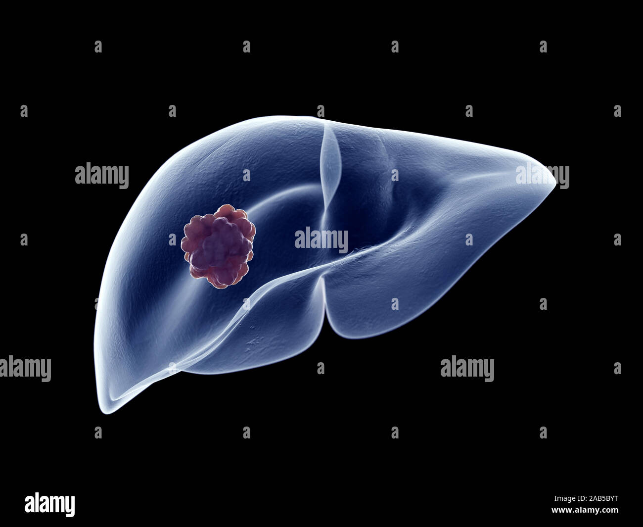 Médicalement en rendu 3d illustration d'un précis des tumeurs du foie Banque D'Images