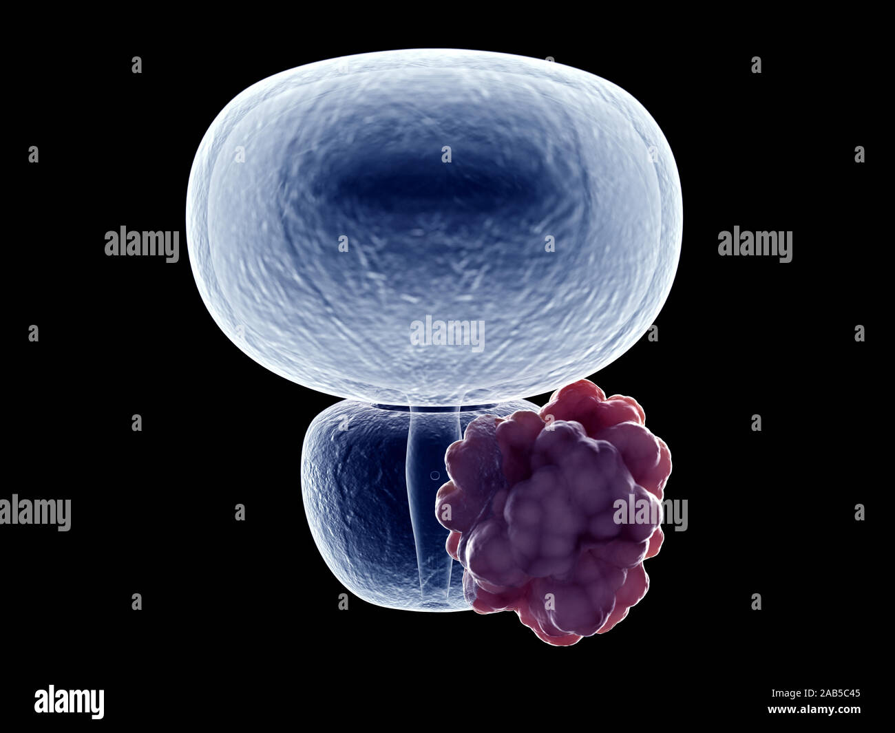 Rendu 3D précis médicalement illustration d'une tumeur de la prostate Banque D'Images