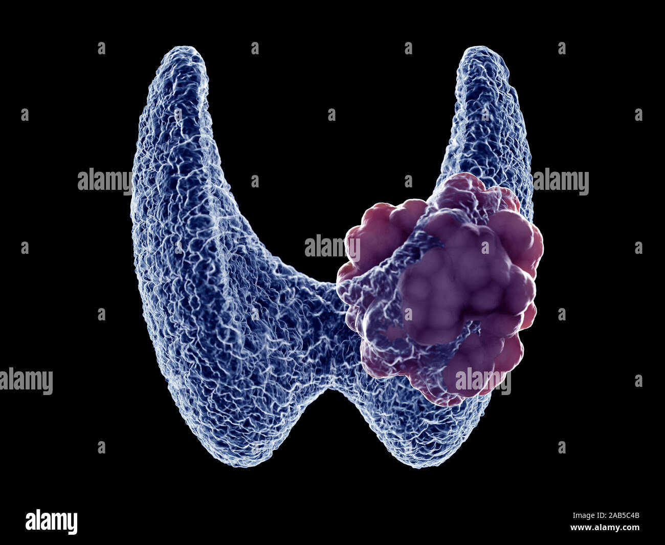 Rendu 3D précis médicalement illustration d'une tumeur de la thyroïde Banque D'Images
