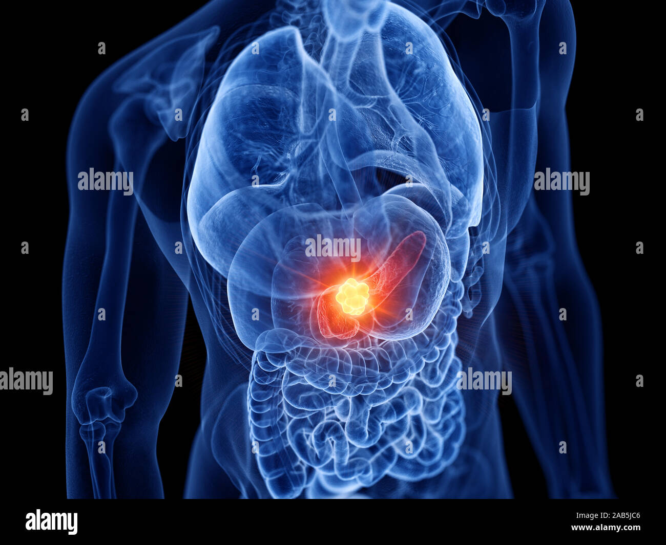Médicalement en rendu 3d illustration de l'exacte du cancer du pancréas Banque D'Images