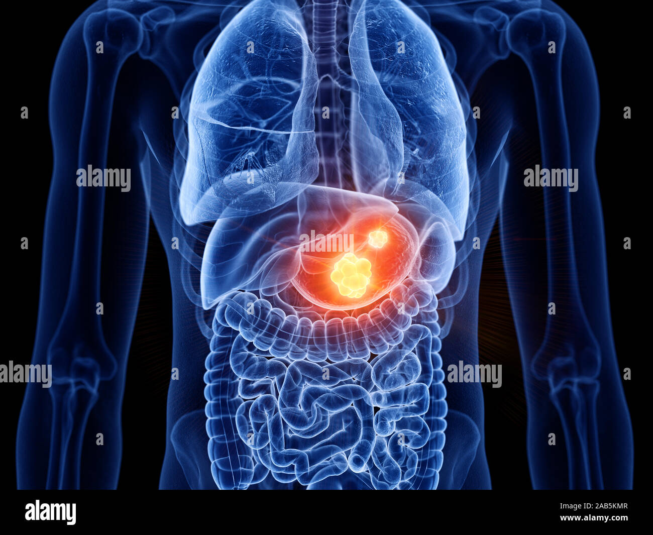 Médicalement en rendu 3d illustration exacte du cancer de l'estomac Banque D'Images