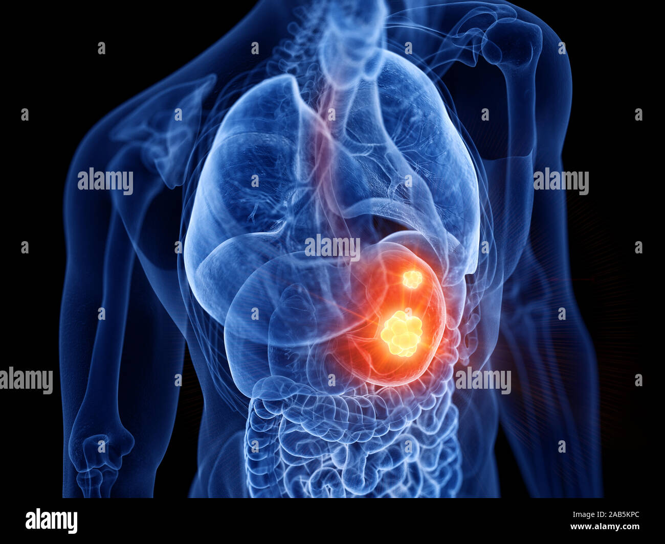 Médicalement en rendu 3d illustration exacte du cancer de l'estomac Banque D'Images