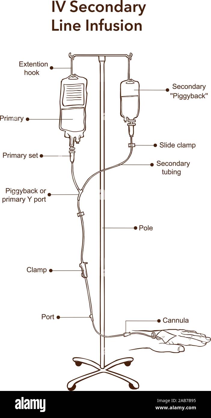 IV perfusion ligne secondaire vector illustration Illustration de Vecteur