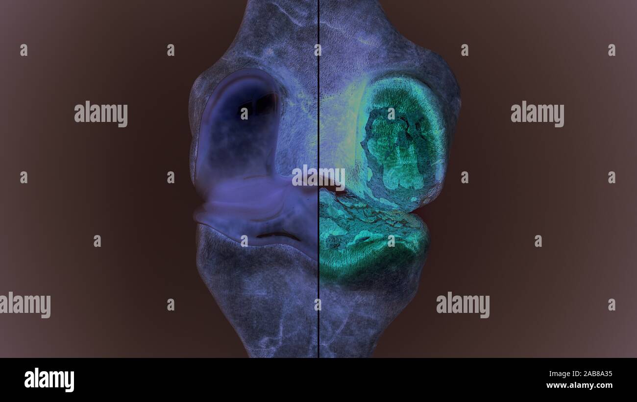 Arthrose du genou sain et en comparaison - haut degré de détail - 3D Rendering Banque D'Images