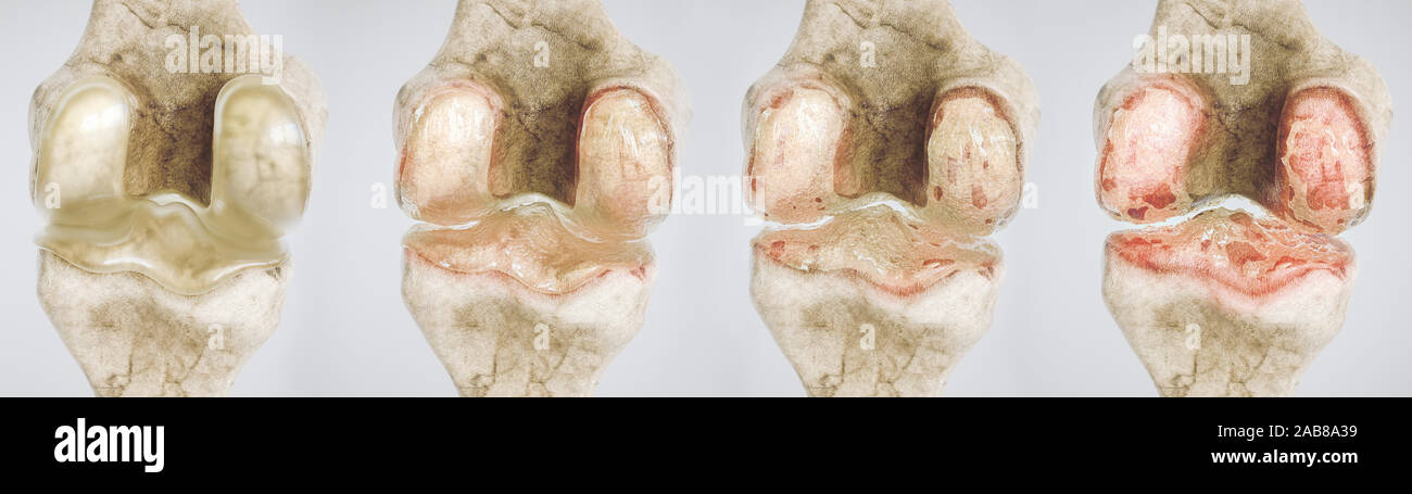 L'arthrose du genou en quatre étapes - haut degré de détail - 3D Rendering Banque D'Images