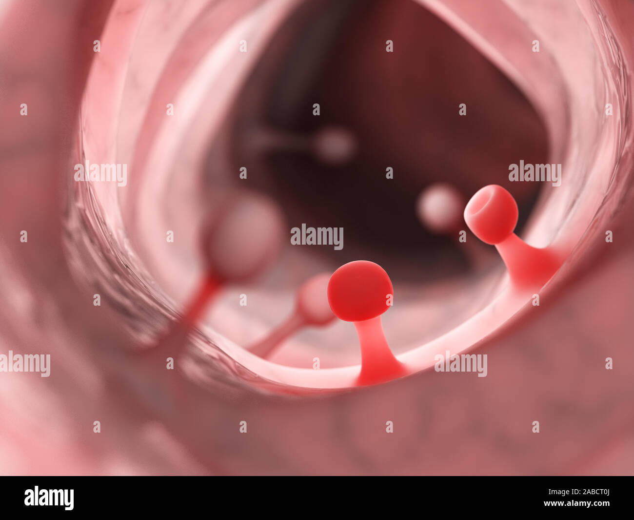 Médicalement en rendu 3d illustration précise de polypes du côlon Banque D'Images