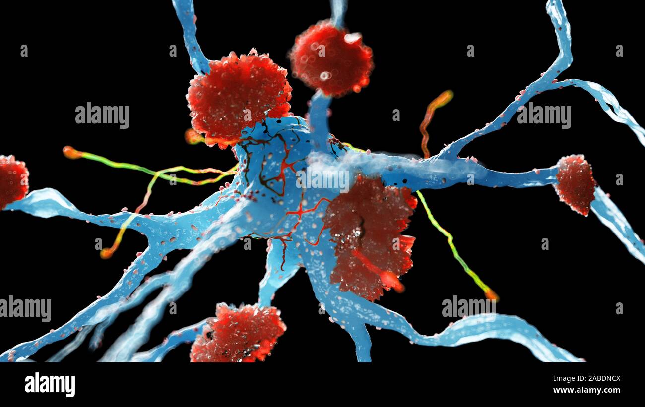 Rendu 3d illustration médicale des cellules nerveuses atteintes de la maladie d'alzheimer Banque D'Images