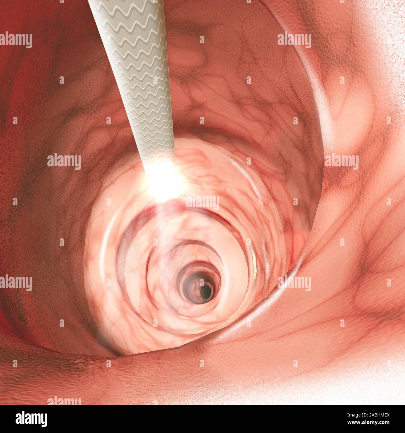 Vue intérieure des parois intestinales. La colonoscopie est l'examen endoscopique du côlon et la partie distale de l'intestin grêle Banque D'Images