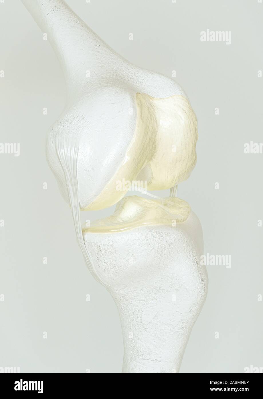 L'arthrose légère - Étape 1- sur l'articulation du genou - haut degré de détail - 3D Rendering Banque D'Images