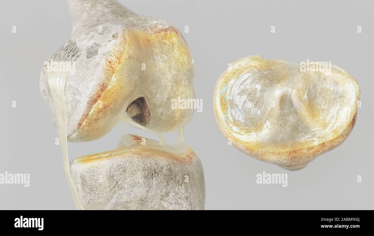 L'arthrose légère - Étape 1- sur l'articulation du genou - haut degré de détail - 3D Rendering Banque D'Images