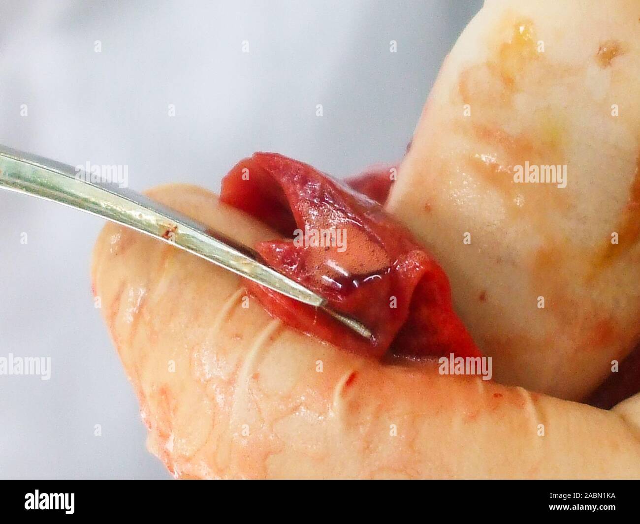 œdème pulmonaire Banque de photographies et d’images à haute résolution Alamy