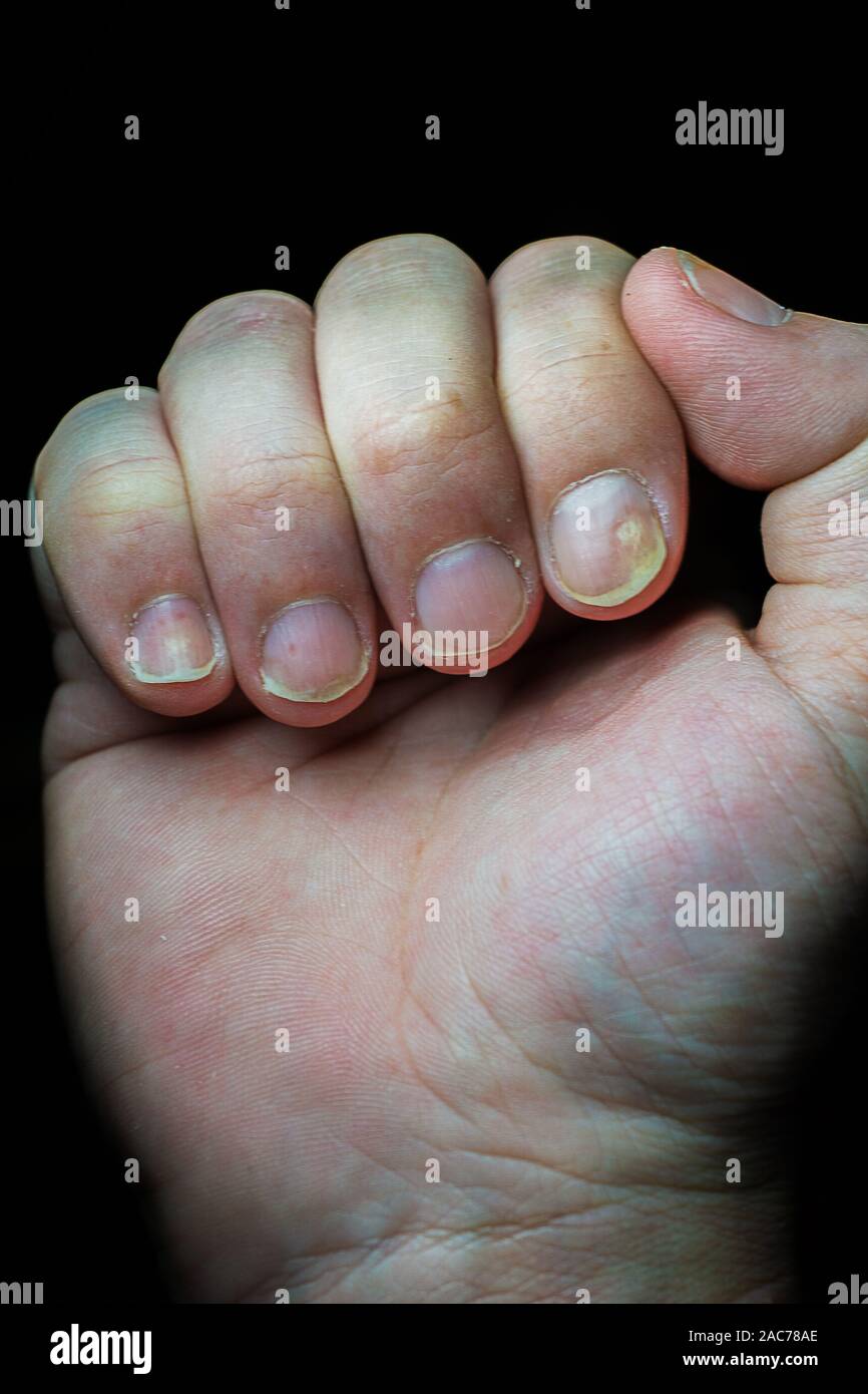 Le psoriasis est une maladie auto-immune qui touche l'ongle et la peau. close up of nail Psoriasis sur fond sombre. Banque D'Images