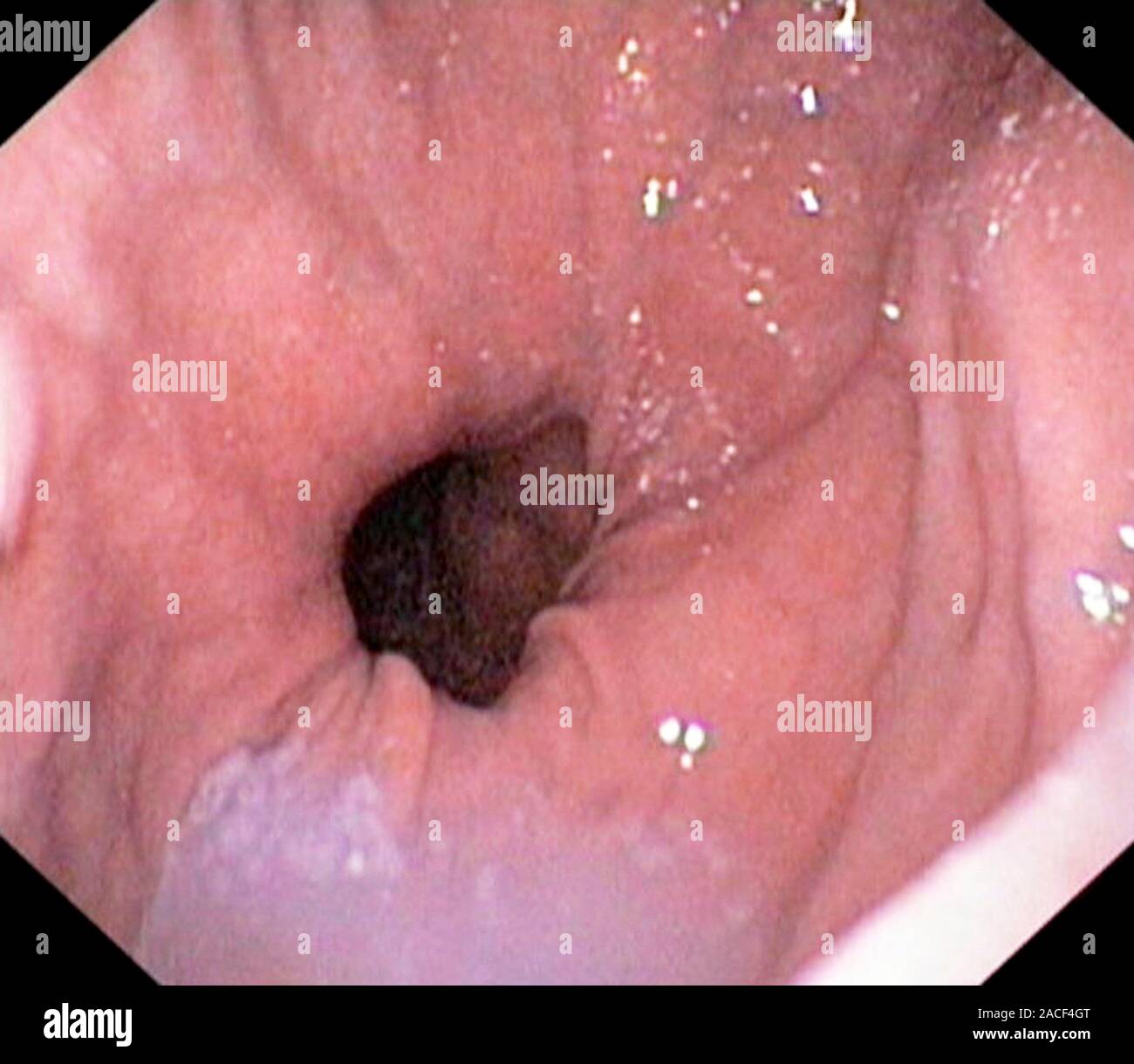 Hernie hiatale. Voir l'endoscope du cardia, la jonction entre l'oesophage et l'estomac, montrant l'intérieur d'une hernie hiatale. Un hiatus hern Banque D'Images