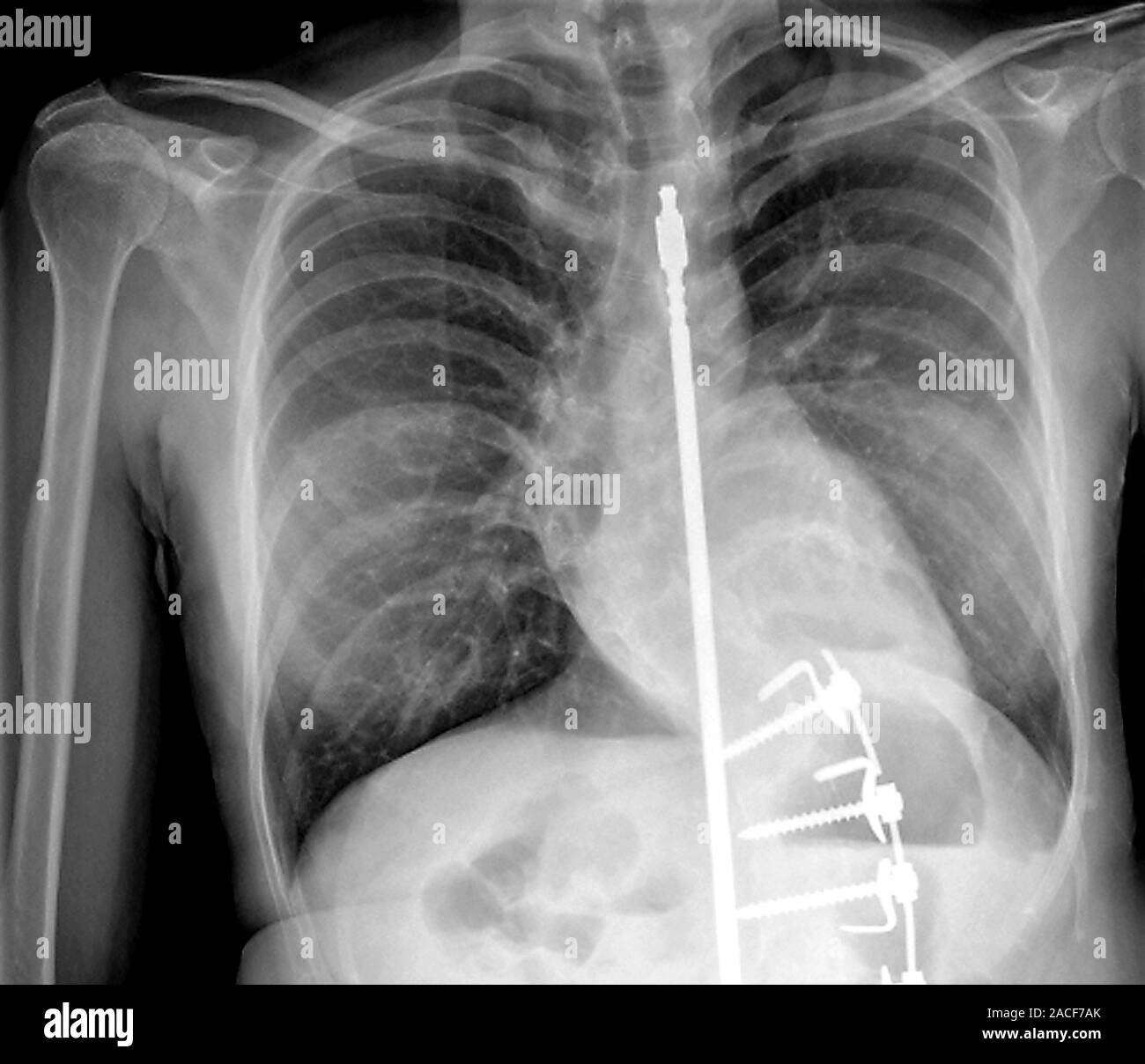 Le traitement de la scoliose. X-ray du torse d'un patient de 34 ans avec  une tige de Harrington en place pour traiter la scoliose. La scoliose est  un latéral (sidewa Photo Stock -