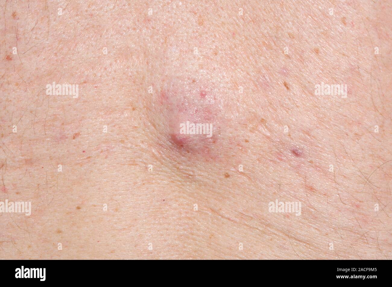 Metabolic disorder infectés (centre) à l