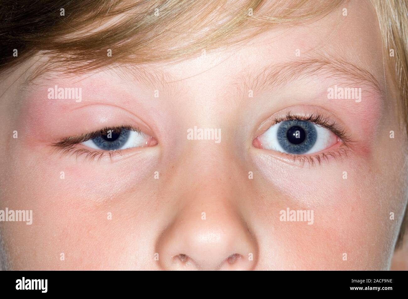 Piqures D Allergie Reaction Allergique A Une Piqure D Insecte Sur La Paupiere Droite D Un Garcon De 6 Ans La Peau Autour De La Morsure Est Devenu Rouge Enflammee D Un Photo Stock Alamy
