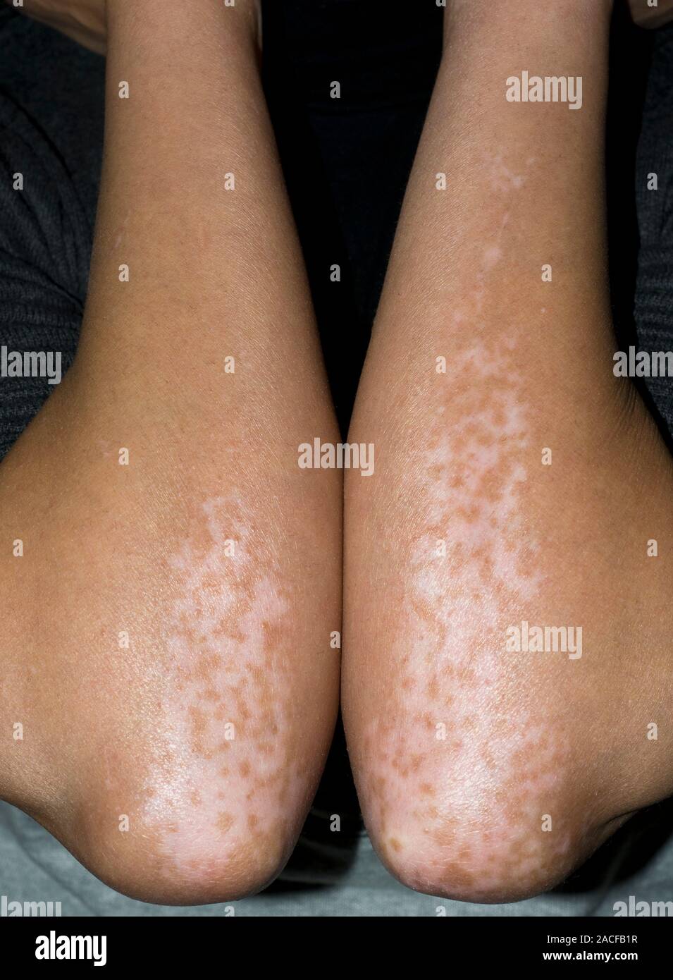 Vitiligo des bras. Femme avec des zones de vitiligo dépigmentation de la peau (rose) sur les coudes et avant-bras. Le vitiligo est une affection qui se caractérise b Banque D'Images