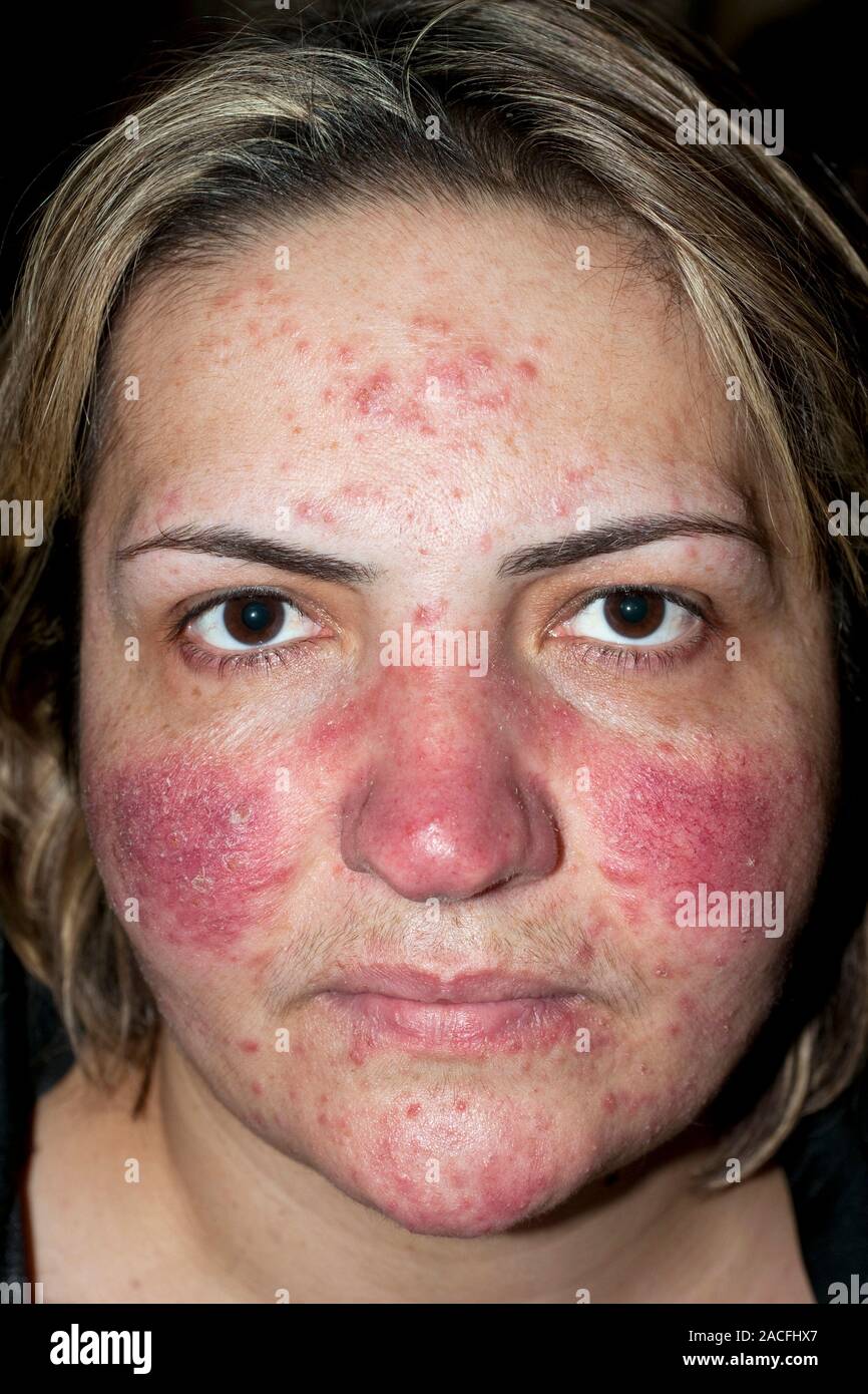 L'Acné rosacée éruptions cutanées sur le visage d'une femme de 40 ...