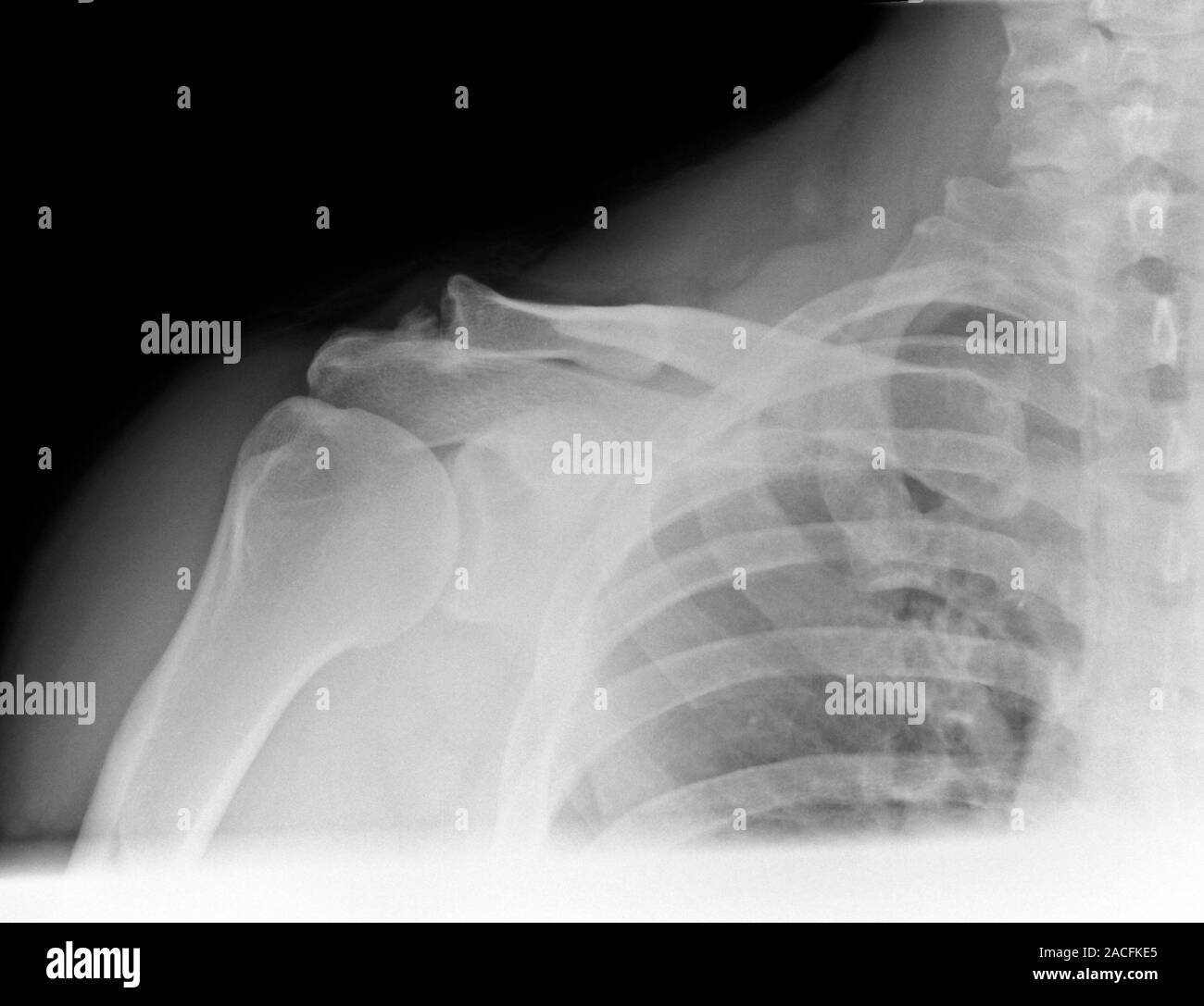 L'arthrose de l'épaule. X-ray du genou d'un patient souffrant d'arthrose  sévère. La fin de l'humérus (os du bras supérieur, à gauche) peut être vu t  Photo Stock - Alamy