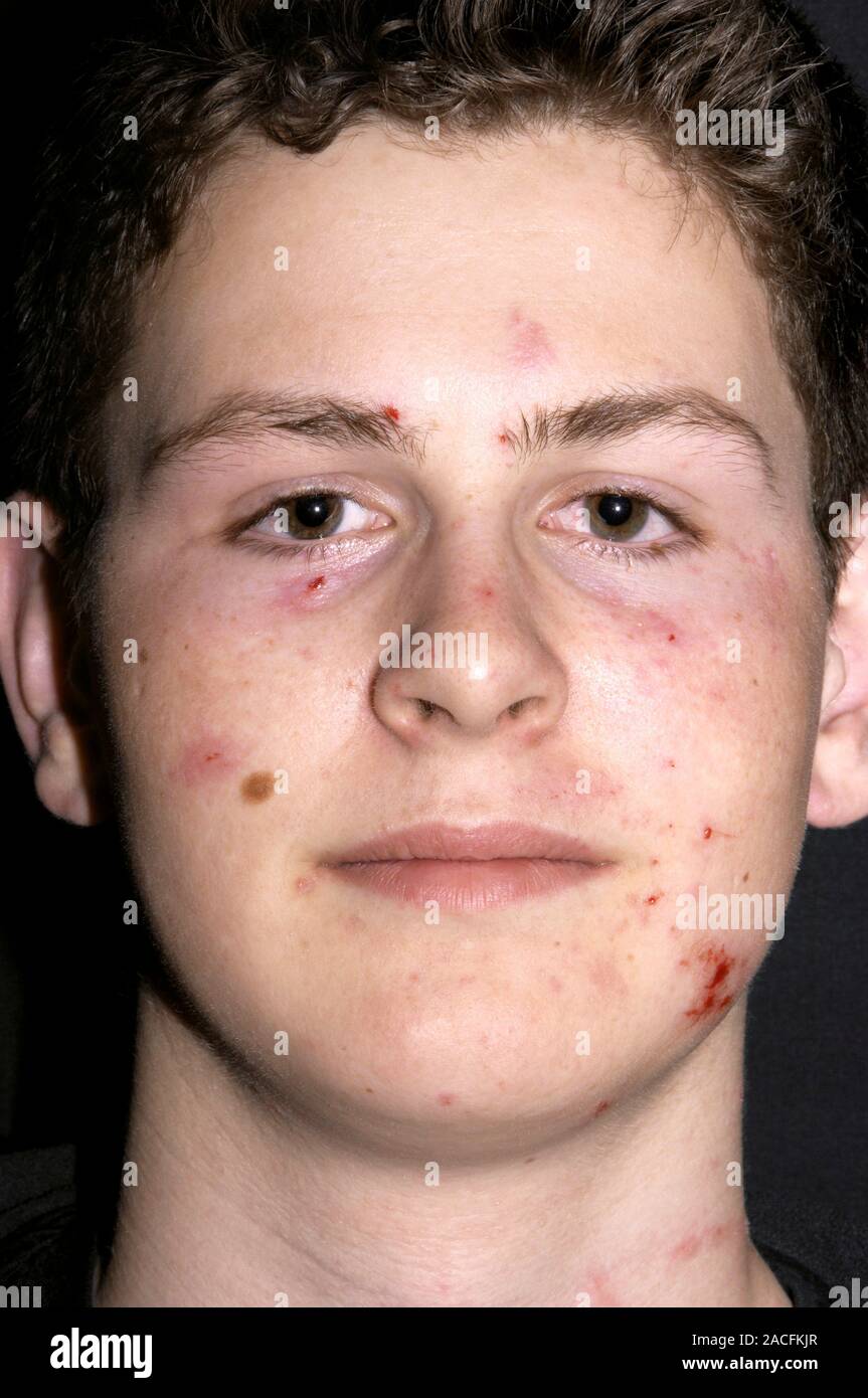 Les blessures d'artifice. Brûlures superficielles sur un garçon de 17 ans de causés par l'explosion d'un feu d'artifice faites maison. Burns de défense de la peau réduire agai Banque D'Images