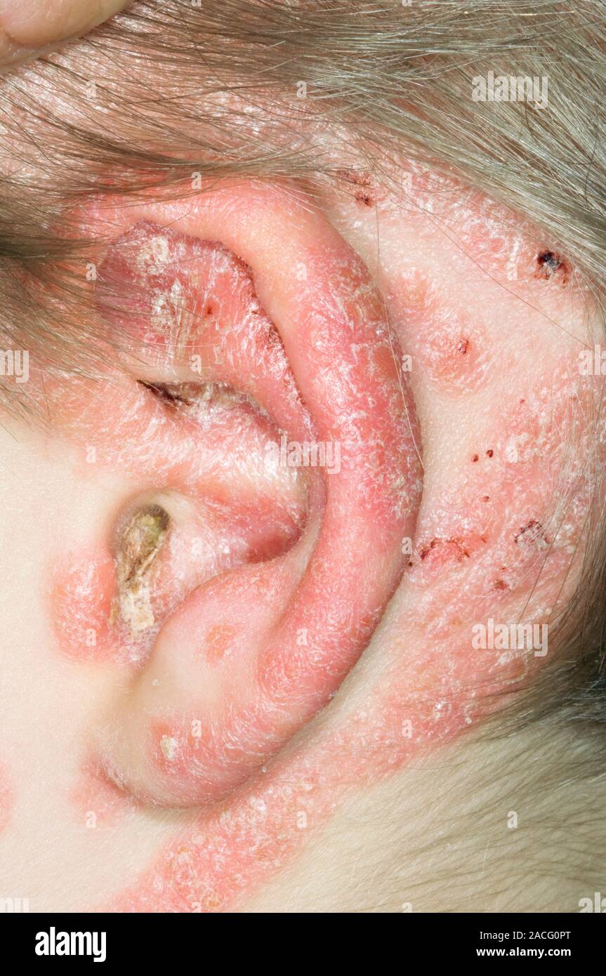 Close-up du psoriasis sur la peau autour de l'oreille (pinna) d'un patient  âgé. Le psoriasis est une affection de la peau où la croissance excessive  de ce de la peau Photo Stock -