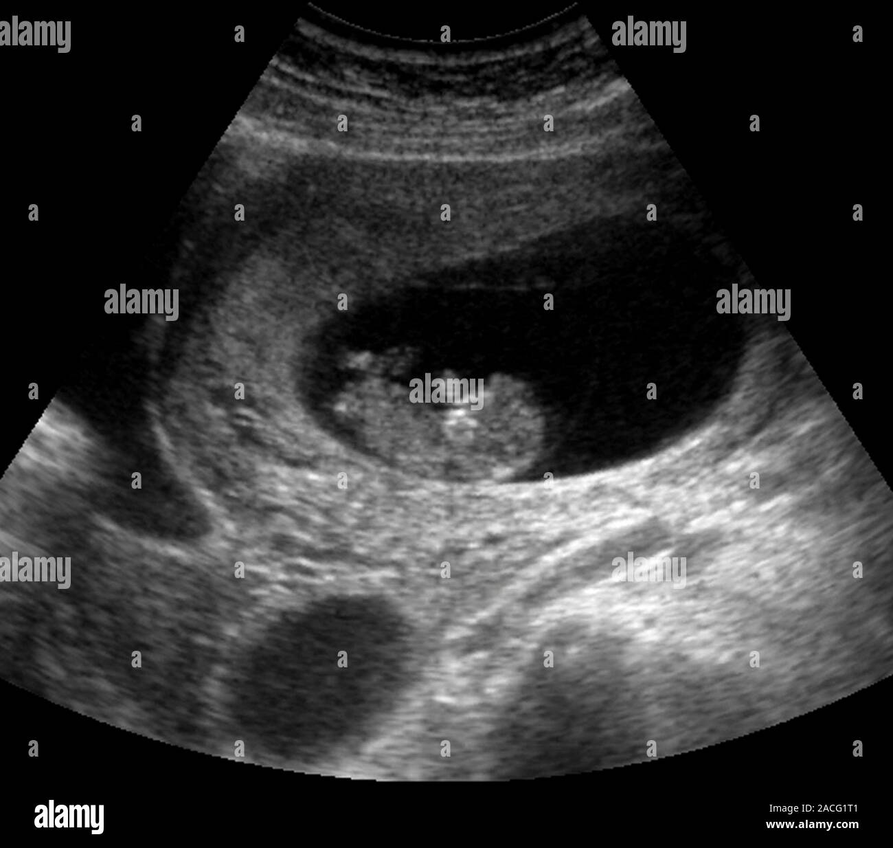 Fœtus à 9 semaines (premier trimestre), l'échographie. Le foetus est vu  avec son siège au centre et la face avec ses ses pieds vers la gauche. Les  Ultras Photo Stock - Alamy