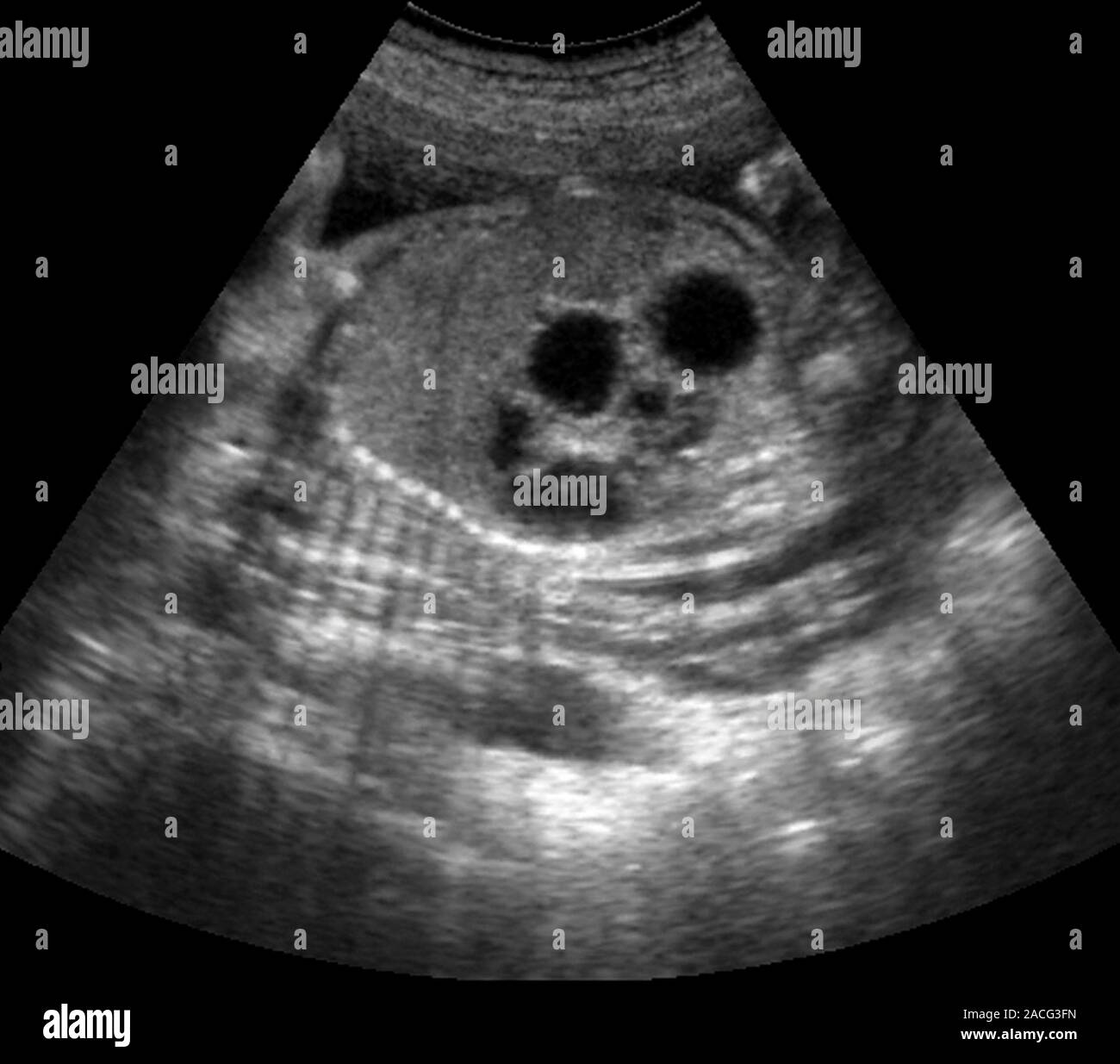 Fœtus avec atrésie duodénale. Échographie montrant une "double bulle