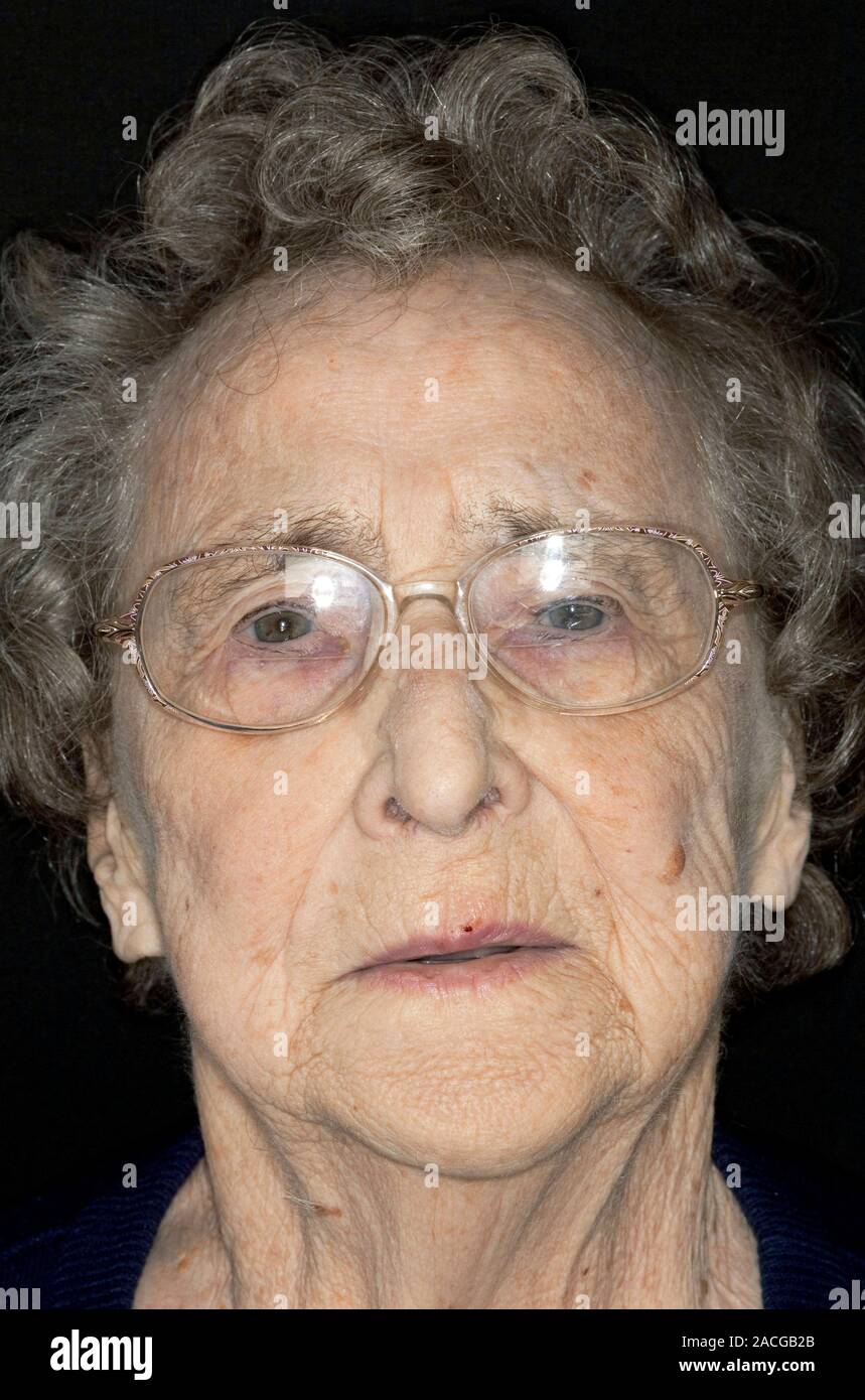 La pâleur de la peau pâle dans le visage d'une patiente âgée de 86 ans, en raison de l'anémie. L'anémie dans le sang a une capacité réduite pour transporter l'oxygène Banque D'Images