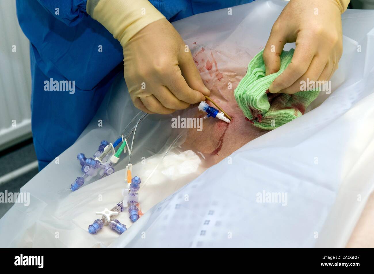 Cathétérisme veineux central. Le cathéter veineux central soit inséré