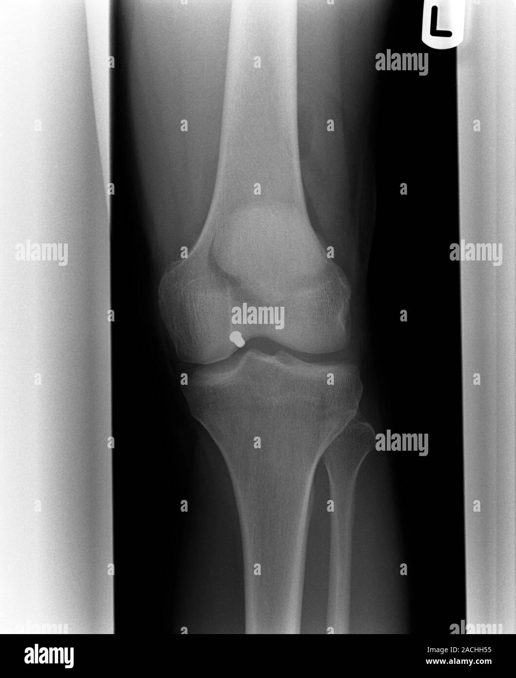 Blessures d'armes à feu. Vue frontale radiographie d'un patient qui a reçu  une balle dans le genou. Un pellet (point blanc) peut être vu juste en  dessous du genou au centre Photo