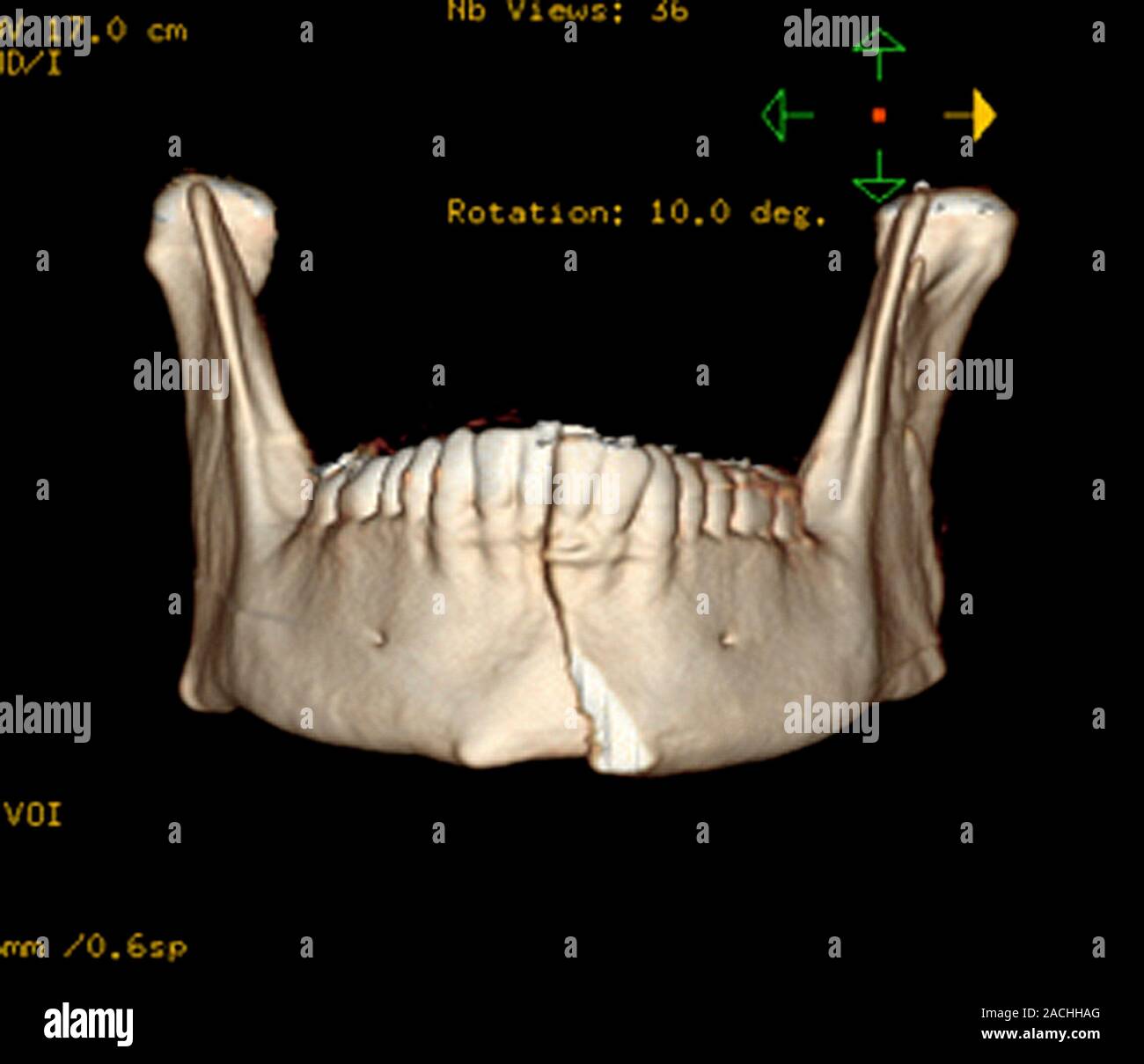 Menton cassé. 3D computed tomography (CT) d'un patient avec une fracture de menton. L'image montre une fracture allant du haut vers le bas de la ch Banque D'Images