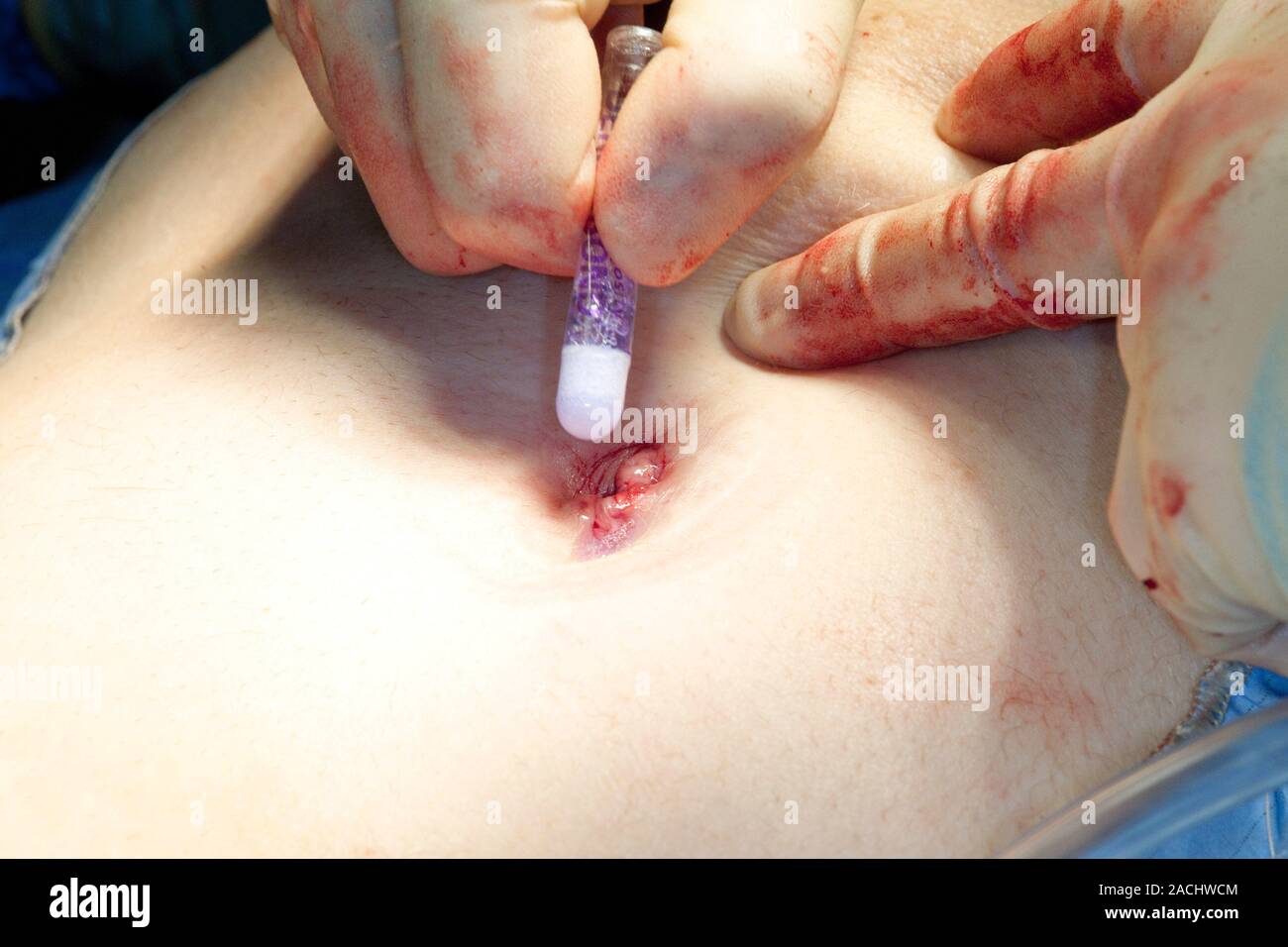 La chirurgie de la vésicule biliaire. L'aide chirurgien colle chirurgicale  pour fermer l'incision du patient dans un nombril (ombilic) après avoir  enlevé leur culot b Photo Stock - Alamy