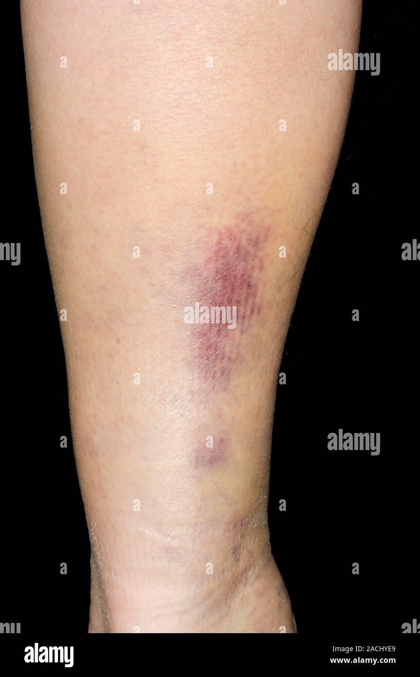 D'ecchymoses sur le mollet de la jambe dans un patient de sexe masculin de 59 ans, causée par une déchirure des muscles du mollet. C'est un sport par la lésion. Banque D'Images