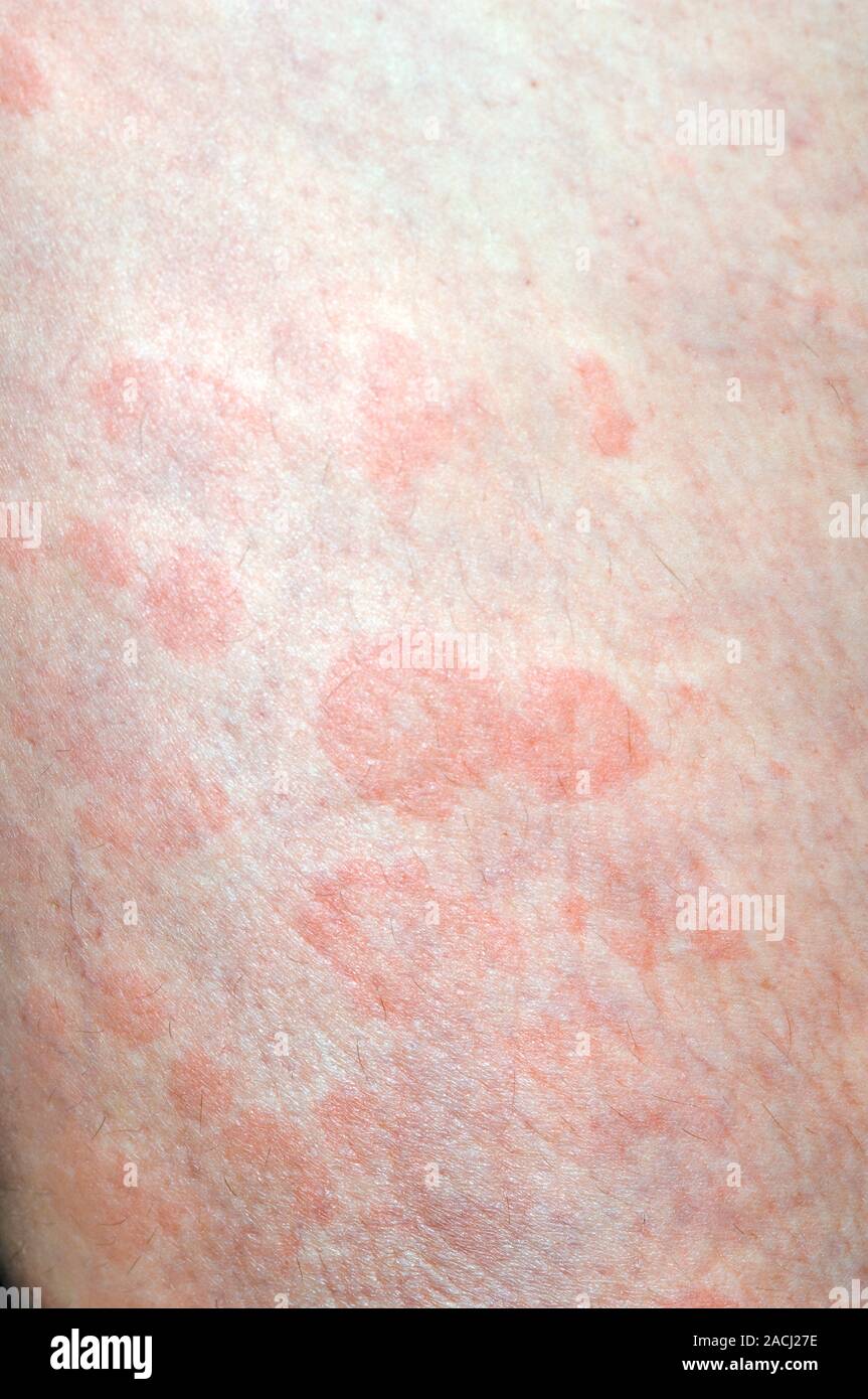 Éruption rouge de l'urticaire (urticaire) sur la jambe d'une patiente âgée de 50 ans. Aussi