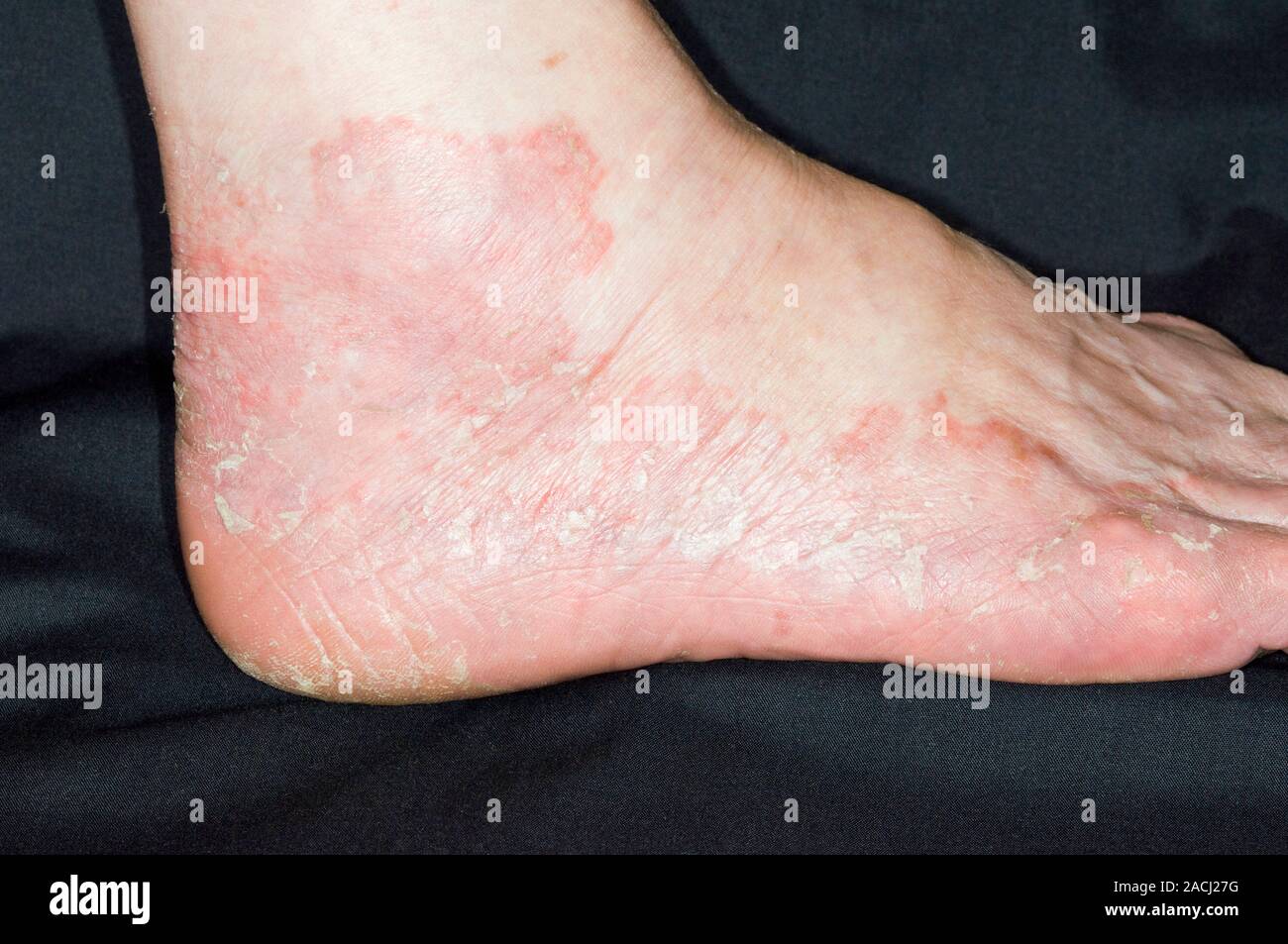 Close-up de plaques rouges de la peau à l'échelle sur le pied d ...