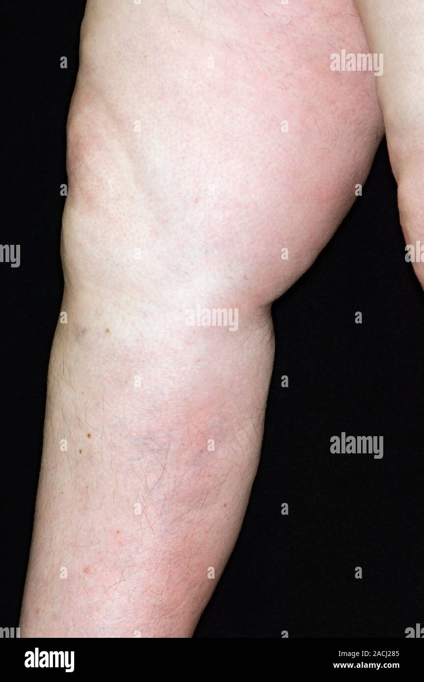 Gonflé et rougi jambe dans une patiente de 66 ans avec une thrombose veineuse profonde (TVP). Tvp est la formation d'un caillot (thrombus) dans les basses profondes Banque D'Images