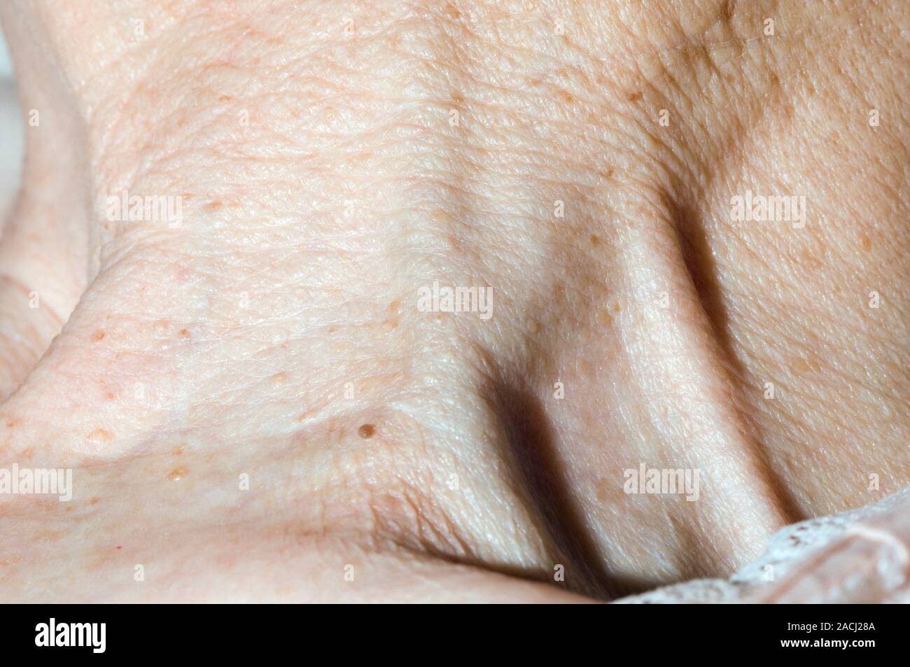 Vue de la veine jugulaire gonflée (au centre) dans le cou d'une ...