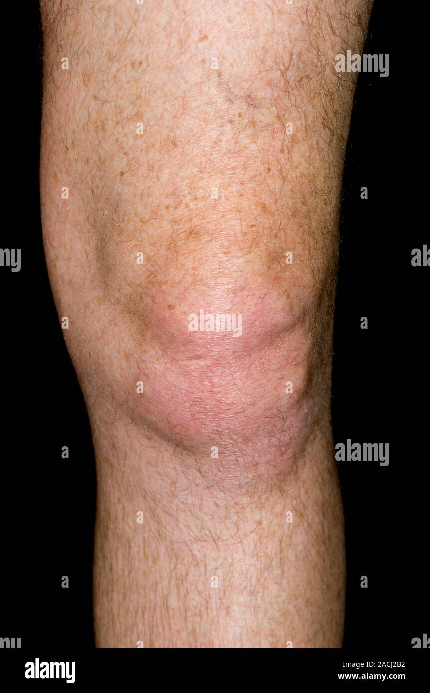 La goutte du genou gauche dans un patient de sexe masculin, 57 ans. La  goutte est un trouble du métabolisme de l'acide urique qui peut résulter en  un dépôt de cristaux d'urate